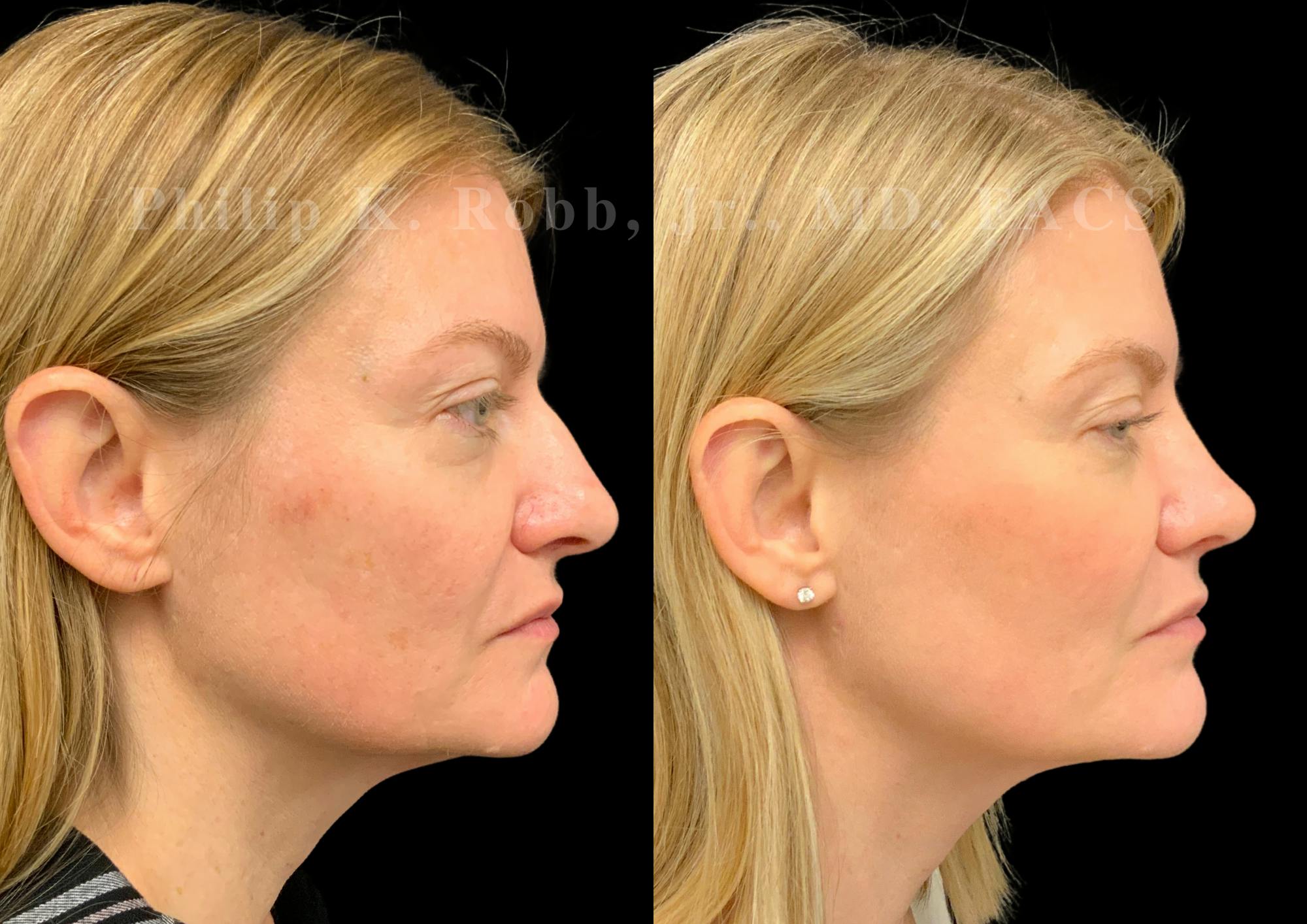 Ultrasonic Rhinoplasty Before & After Gallery - Patient 924201 - Image 1