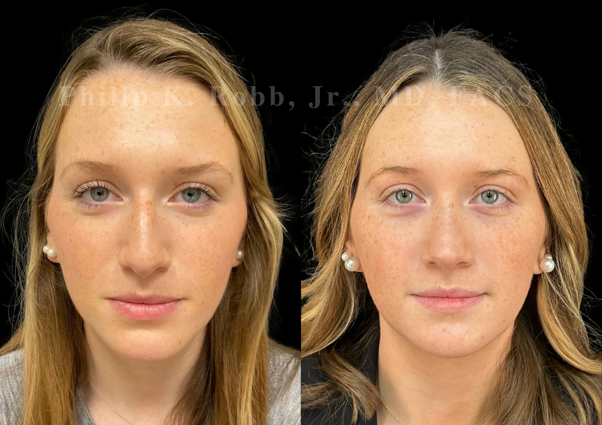 Ultrasonic Rhinoplasty Before & After Gallery - Patient 168535 - Image 3