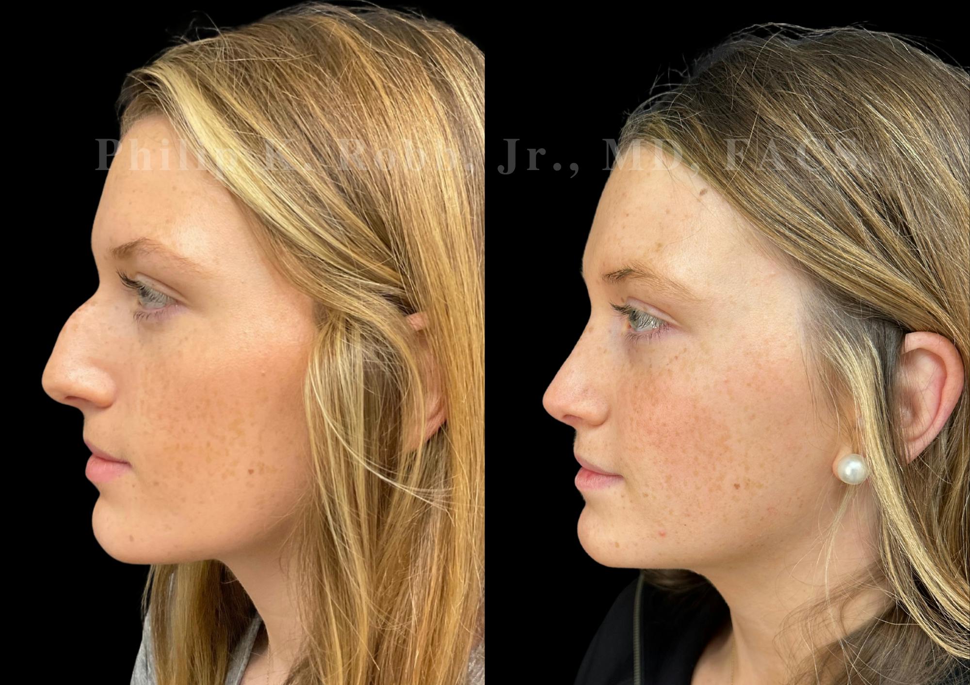 Ultrasonic Rhinoplasty Before & After Gallery - Patient 168535 - Image 5
