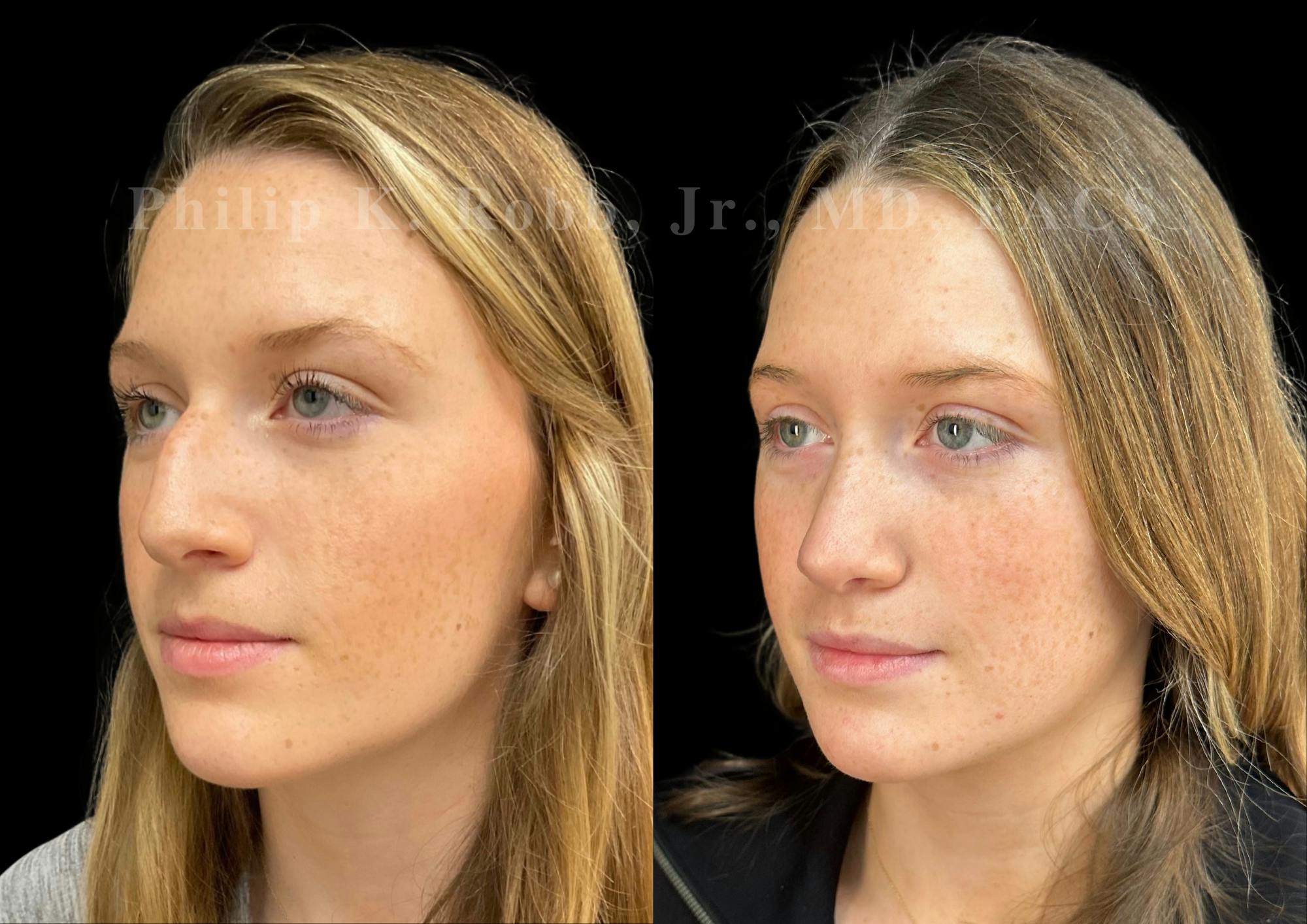 Ultrasonic Rhinoplasty Before & After Gallery - Patient 168535 - Image 4