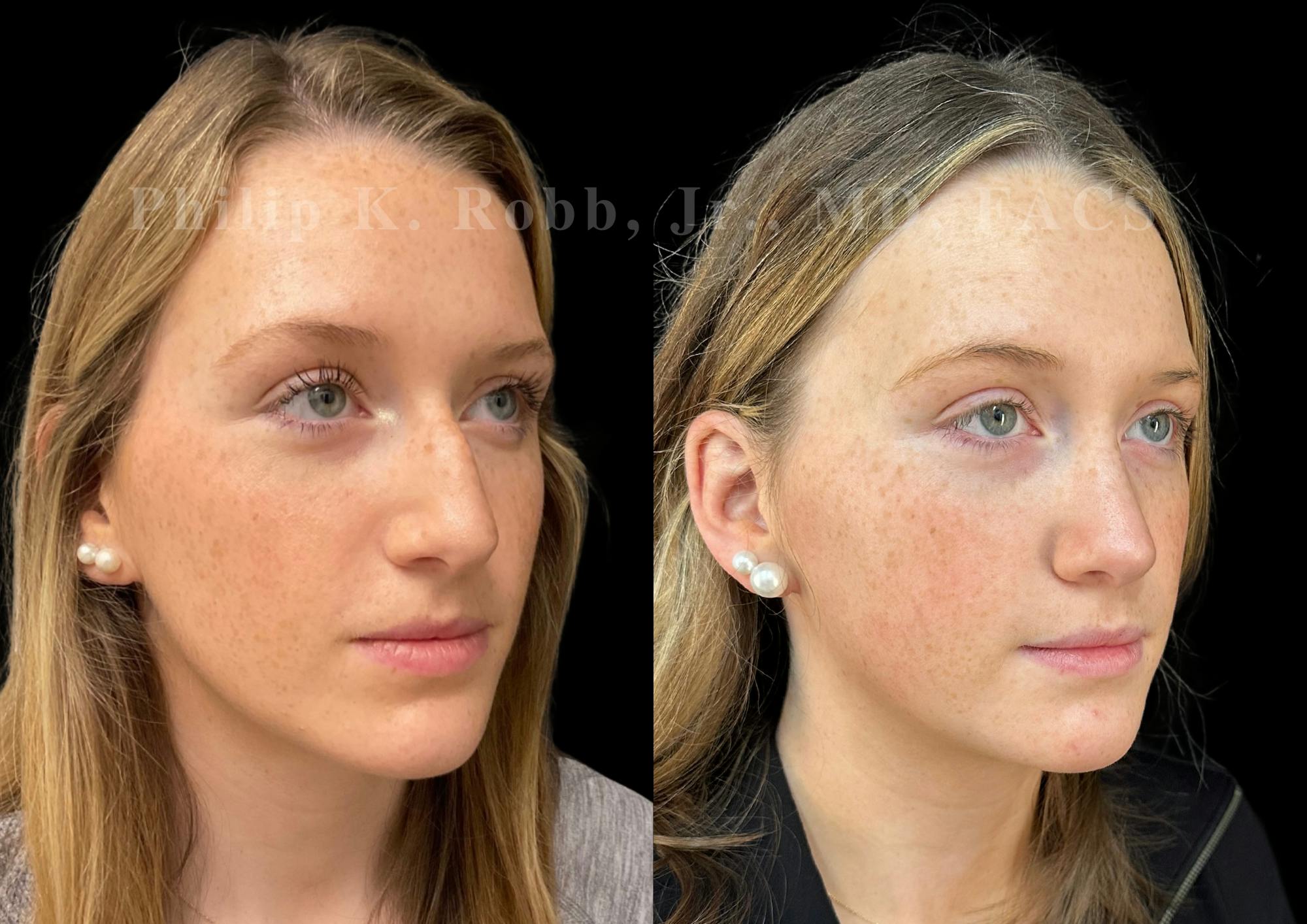 Ultrasonic Rhinoplasty Before & After Gallery - Patient 168535 - Image 2