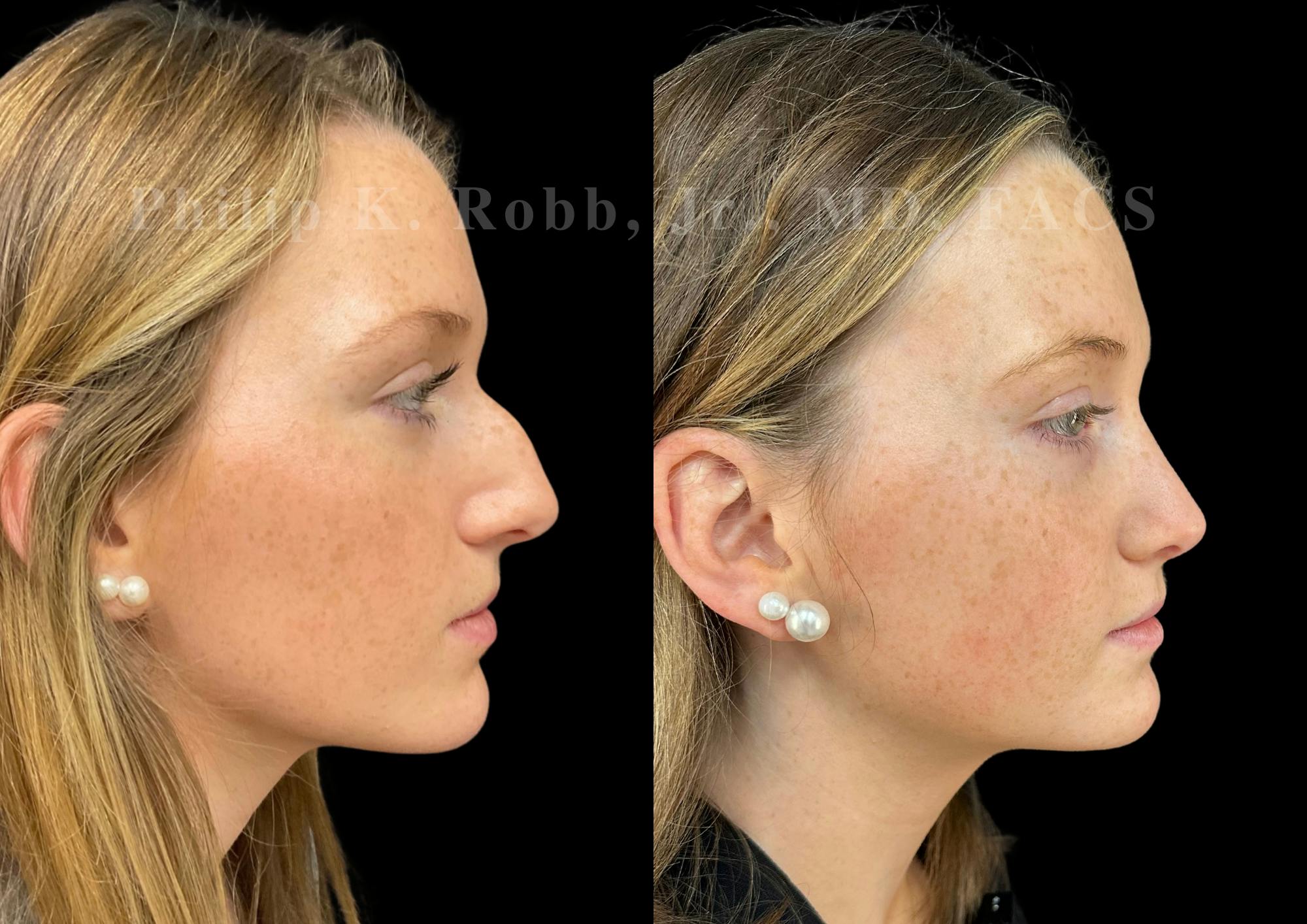 Ultrasonic Rhinoplasty Before & After Gallery - Patient 168535 - Image 1