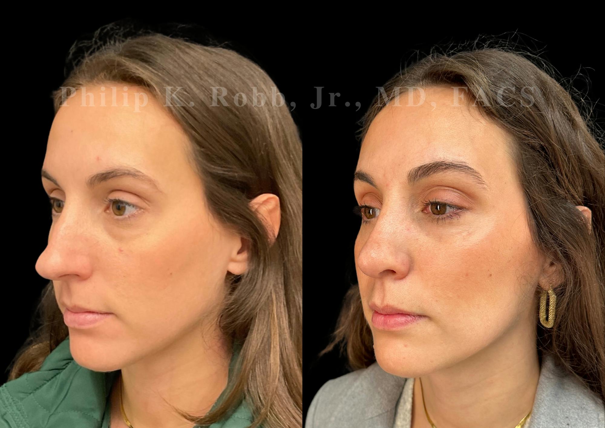 Ultrasonic Rhinoplasty Before & After Gallery - Patient 113063 - Image 4