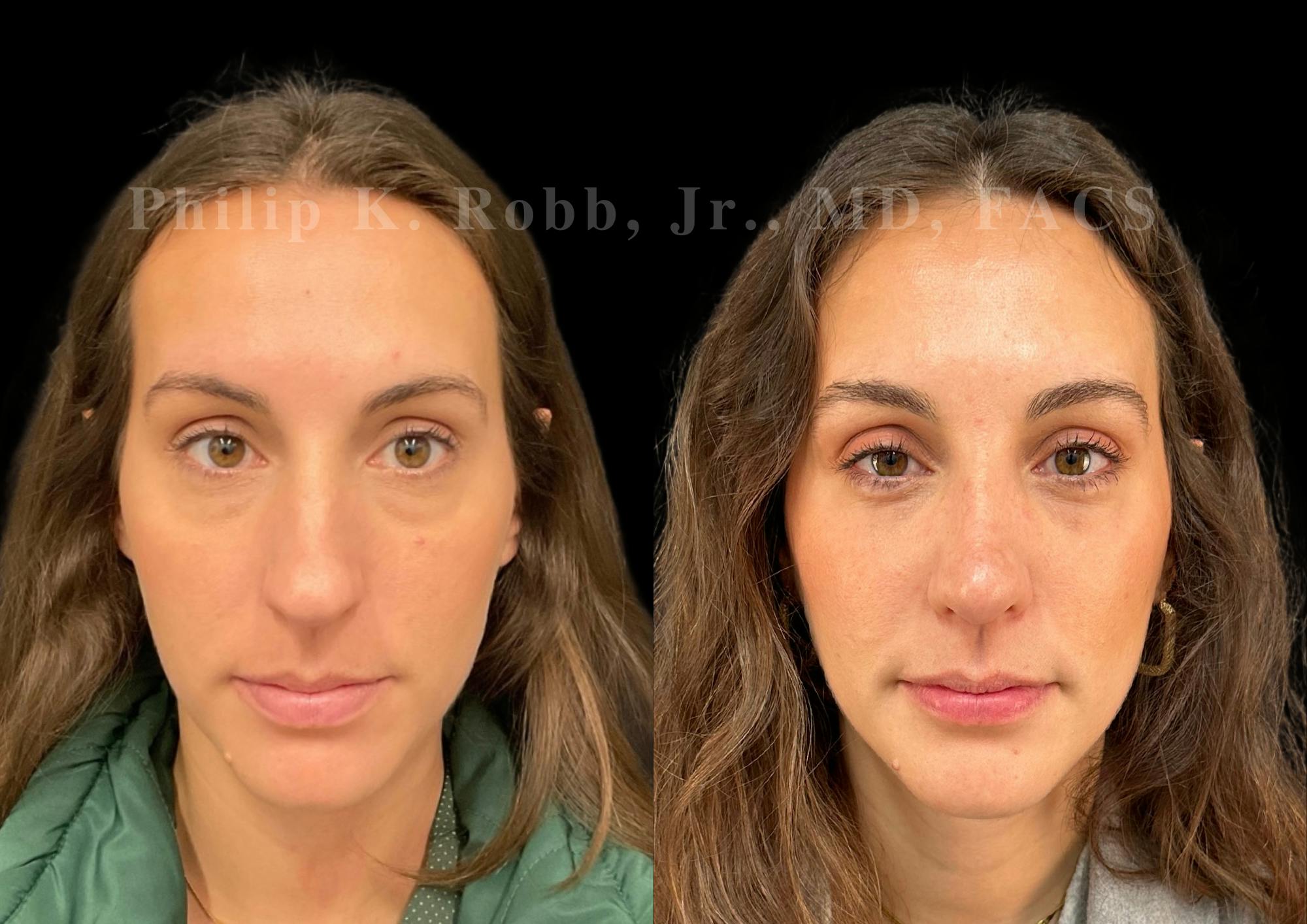 Ultrasonic Rhinoplasty Before & After Gallery - Patient 113063 - Image 3