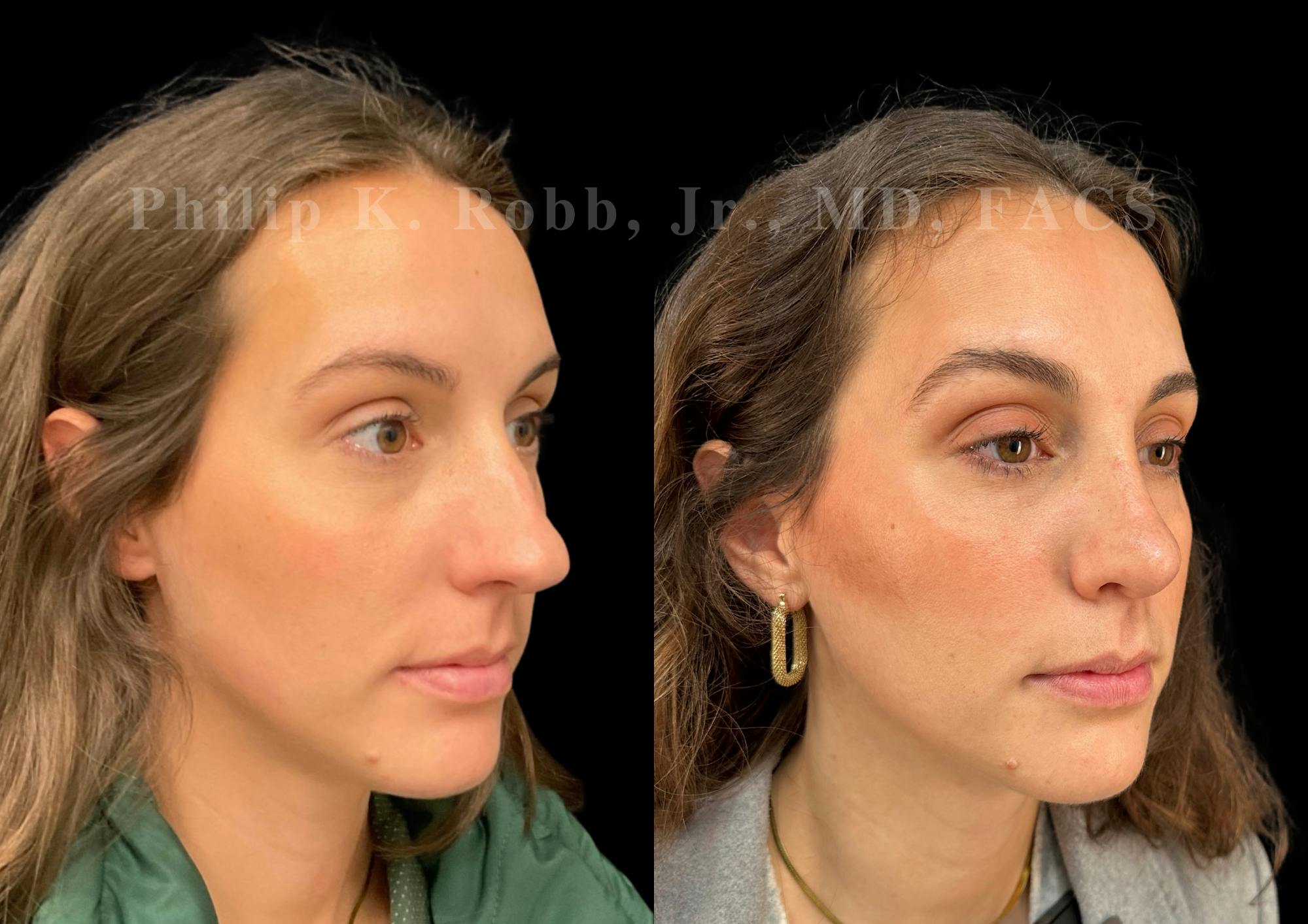 Ultrasonic Rhinoplasty Before & After Gallery - Patient 113063 - Image 2
