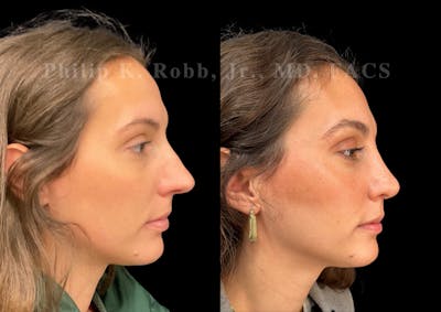 Ultrasonic Rhinoplasty Before & After Gallery - Patient 113063 - Image 1