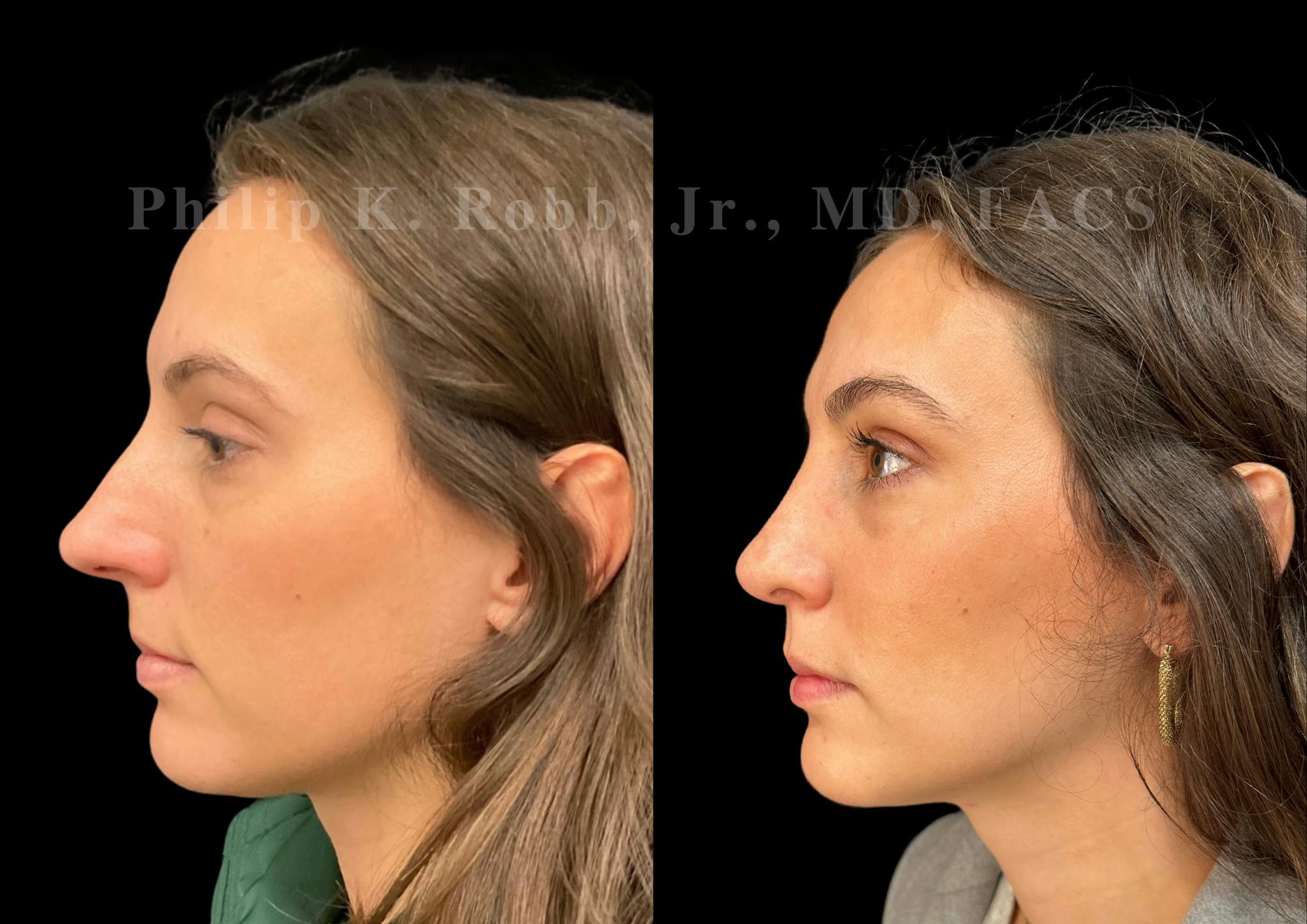 Ultrasonic Rhinoplasty Before & After Gallery - Patient 113063 - Image 5