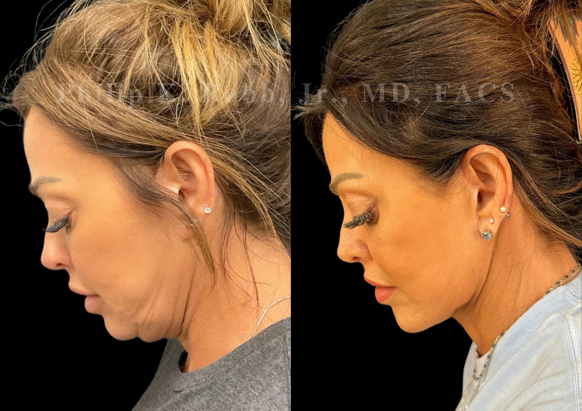 Neck Lift Before & After Gallery - Patient 421207 - Image 2