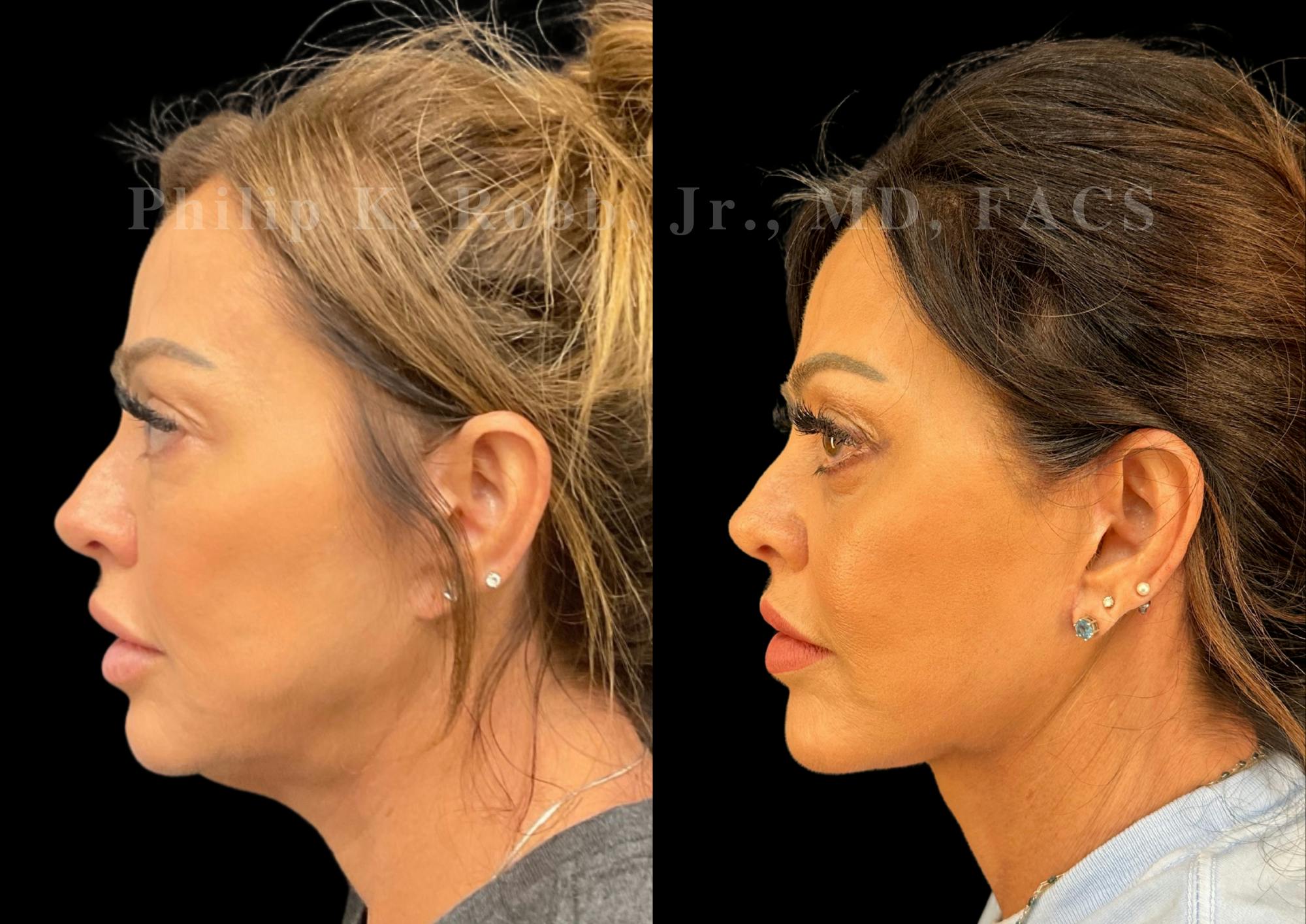 Neck Lift Before & After Gallery - Patient 421207 - Image 1