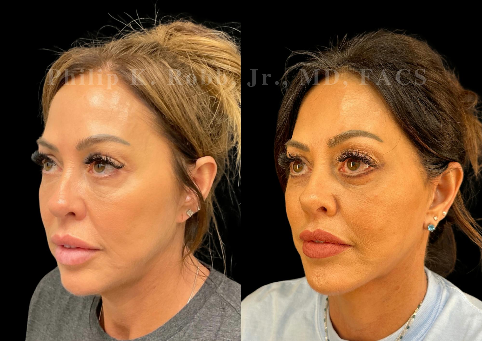 Neck Lift Before & After Gallery - Patient 421207 - Image 3