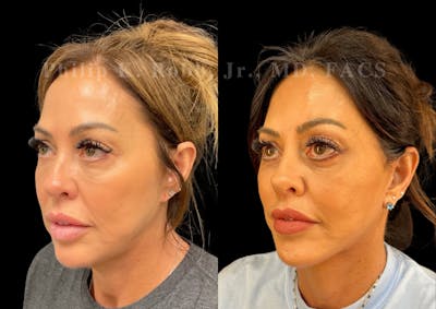 Facelift Before & After Gallery - Patient 153696 - Image 1
