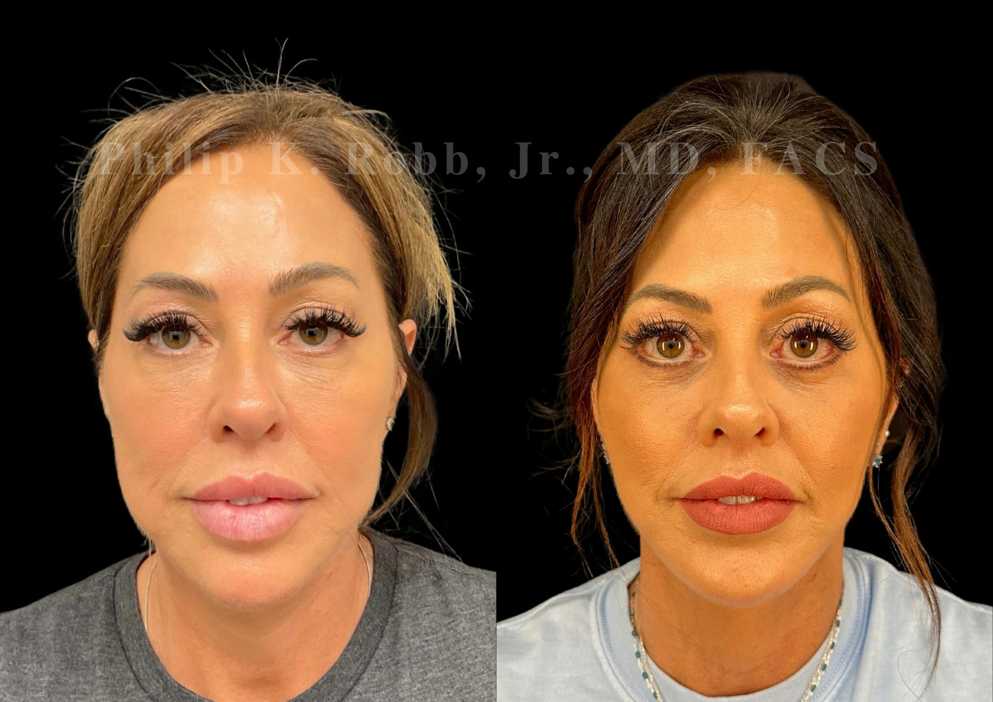 Neck Lift Before & After Gallery - Patient 421207 - Image 4
