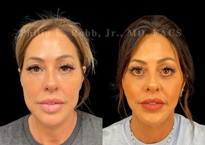 Buccal Fat Reduction Before & After Gallery - Patient 322256 - Image 1
