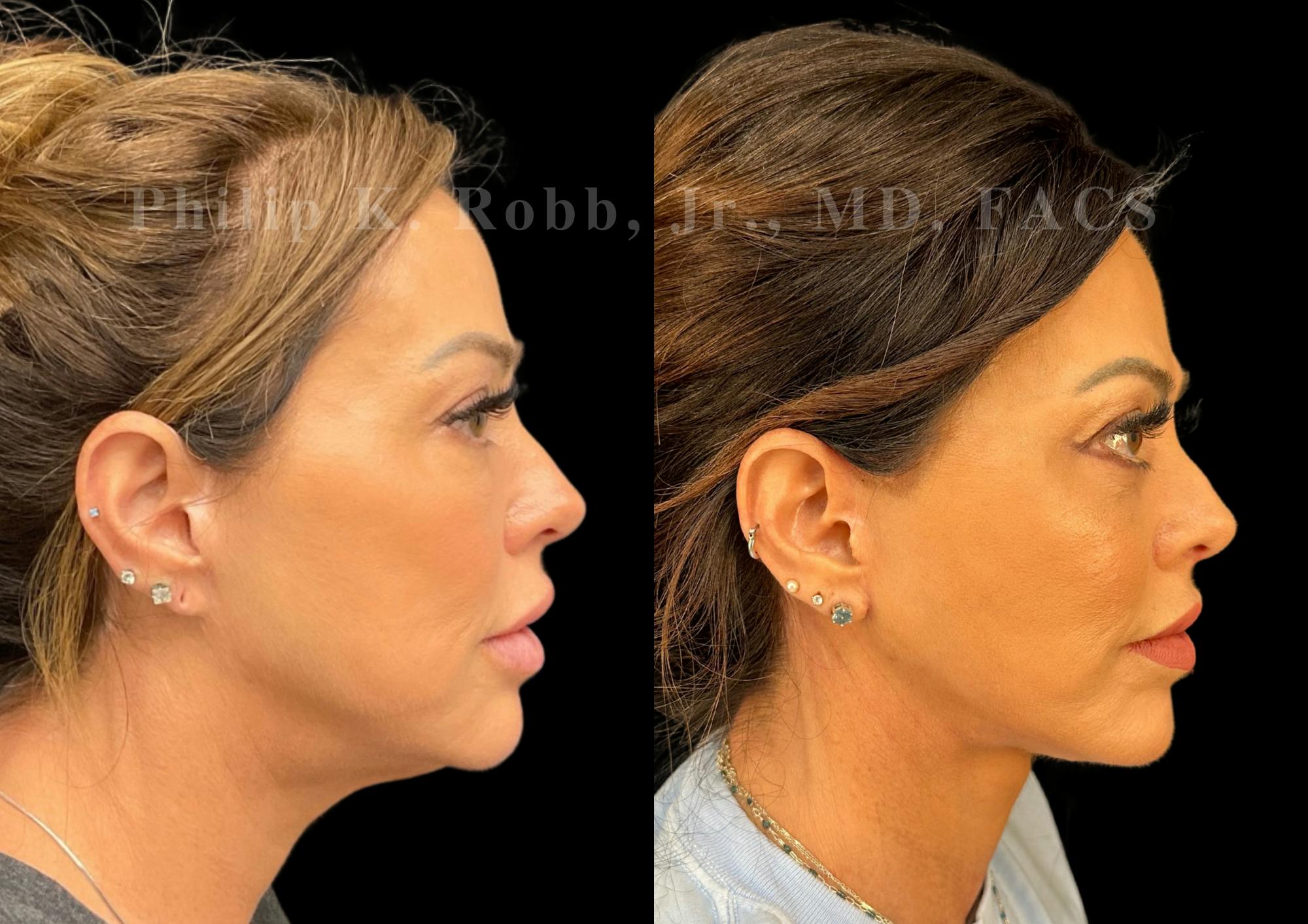 Neck Lift Before & After Gallery - Patient 421207 - Image 6
