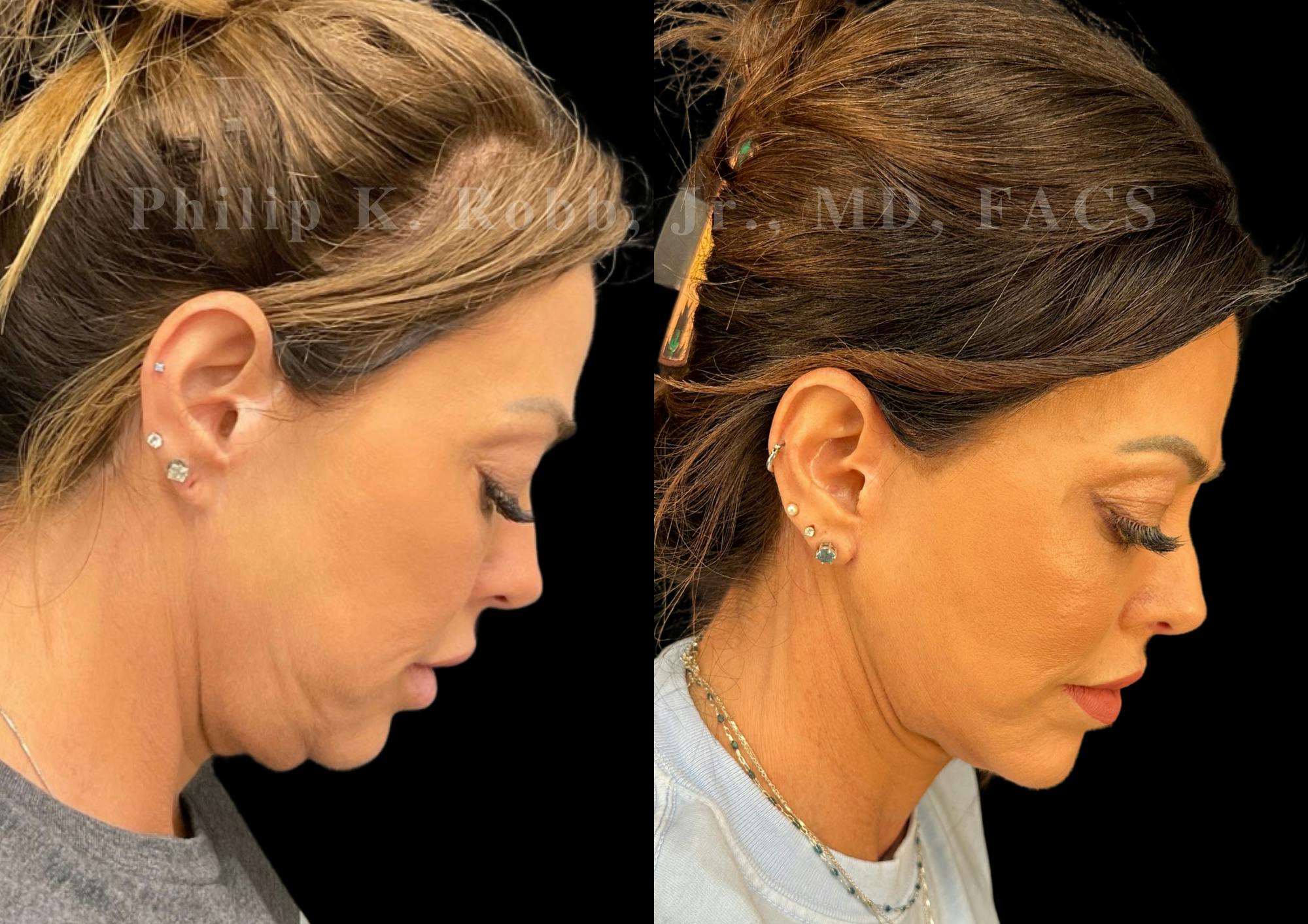 Neck Lift Before & After Gallery - Patient 421207 - Image 7