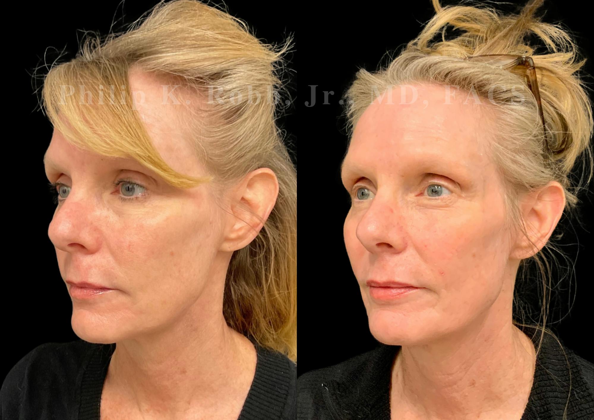 Laser Skin Resurfacing Before & After Gallery - Patient 270358 - Image 2