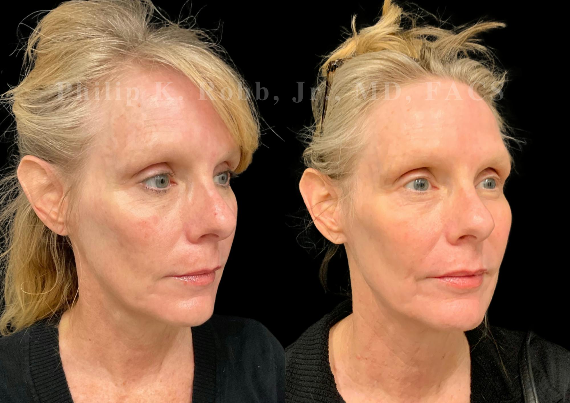 Laser Skin Resurfacing Before & After Gallery - Patient 270358 - Image 4
