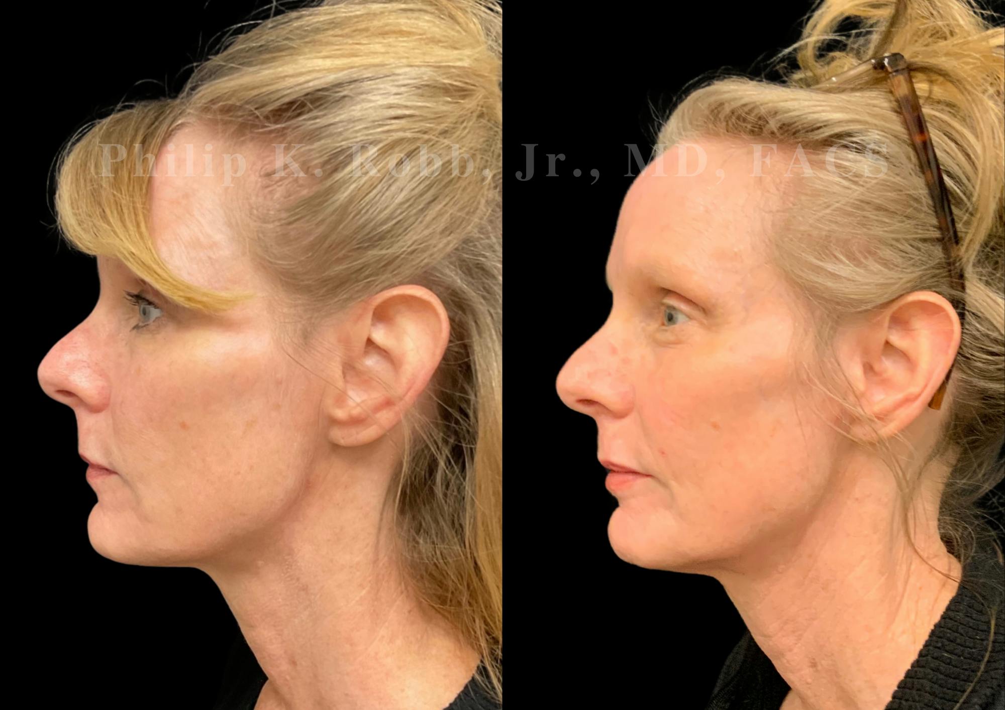 Laser Skin Resurfacing Before & After Gallery - Patient 270358 - Image 3