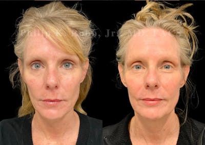 Laser Skin Resurfacing Before & After Gallery - Patient 270358 - Image 1