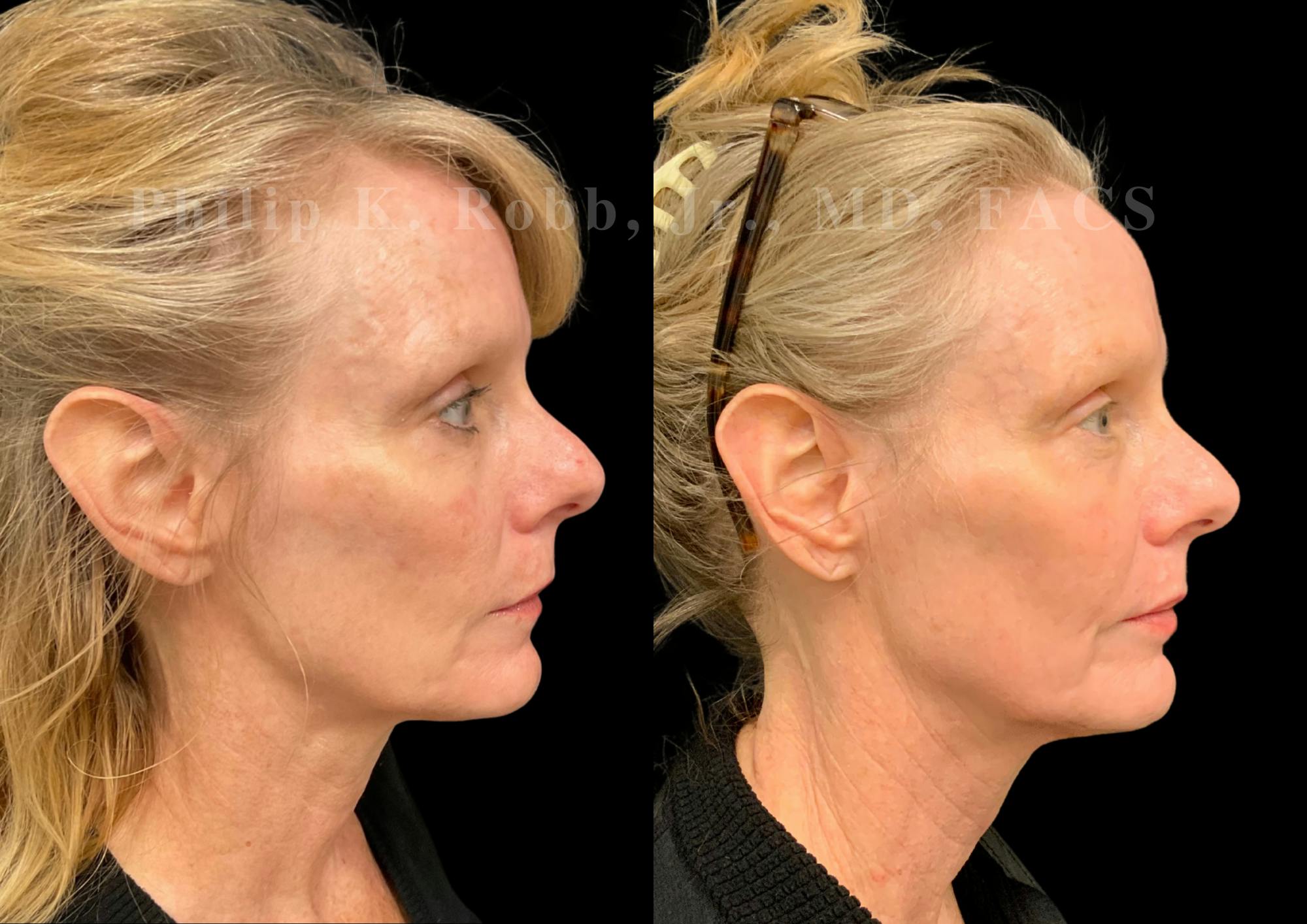 Laser Skin Resurfacing Before & After Gallery - Patient 270358 - Image 5