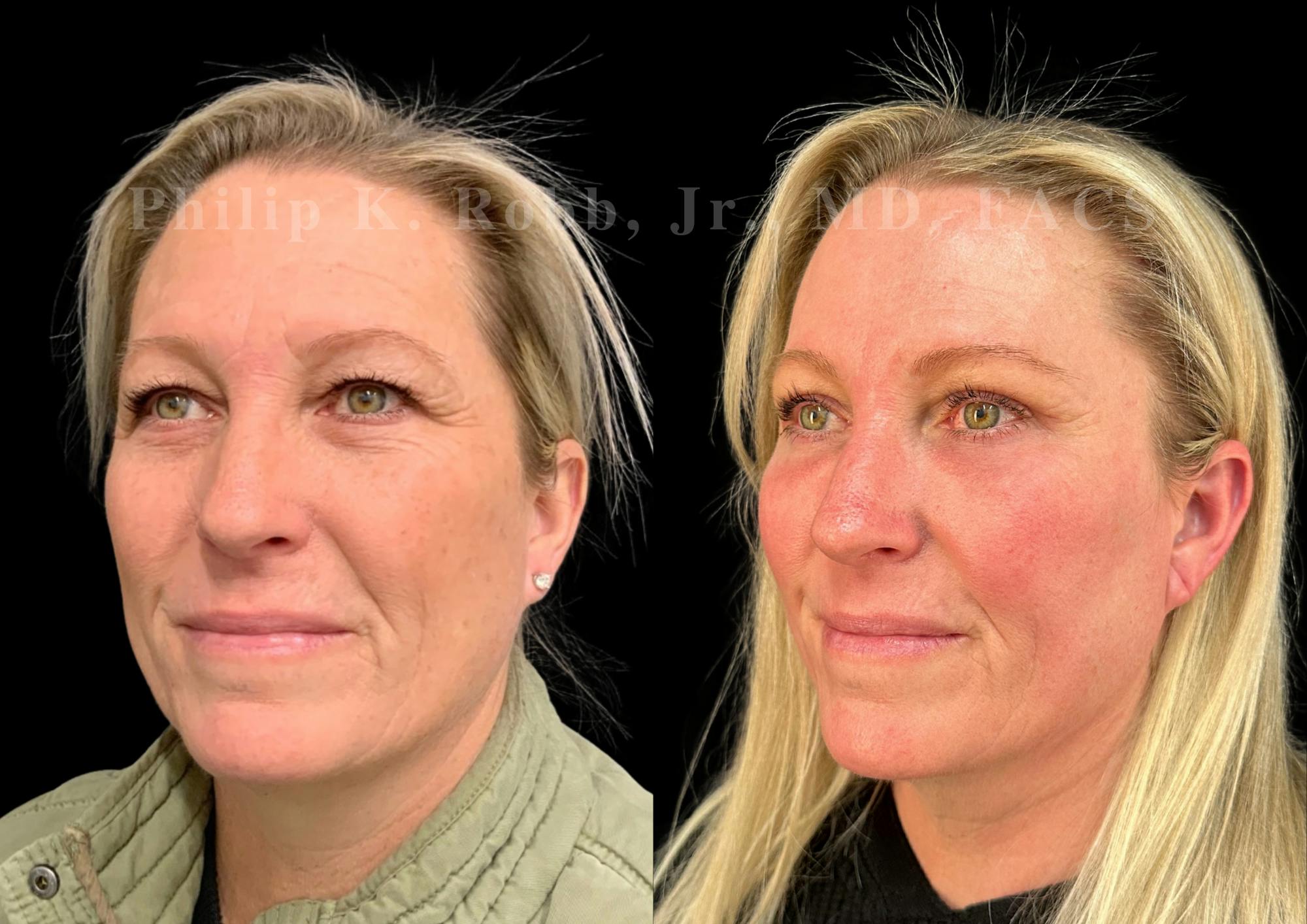 Brow Lift Before & After Gallery - Patient 406939 - Image 2