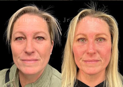 Brow Lift Before & After Gallery - Patient 406939 - Image 1