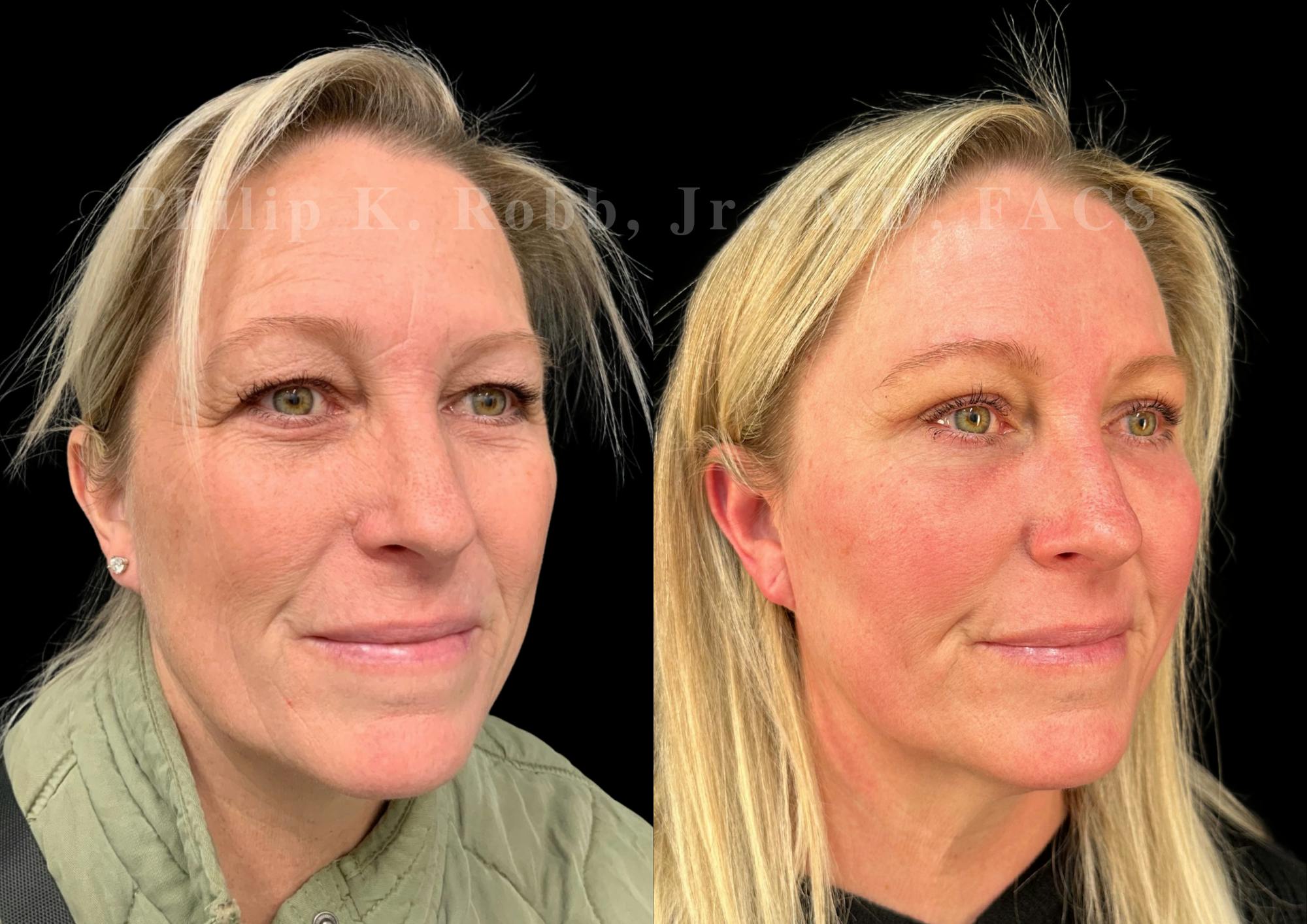 Brow Lift Before & After Gallery - Patient 406939 - Image 4