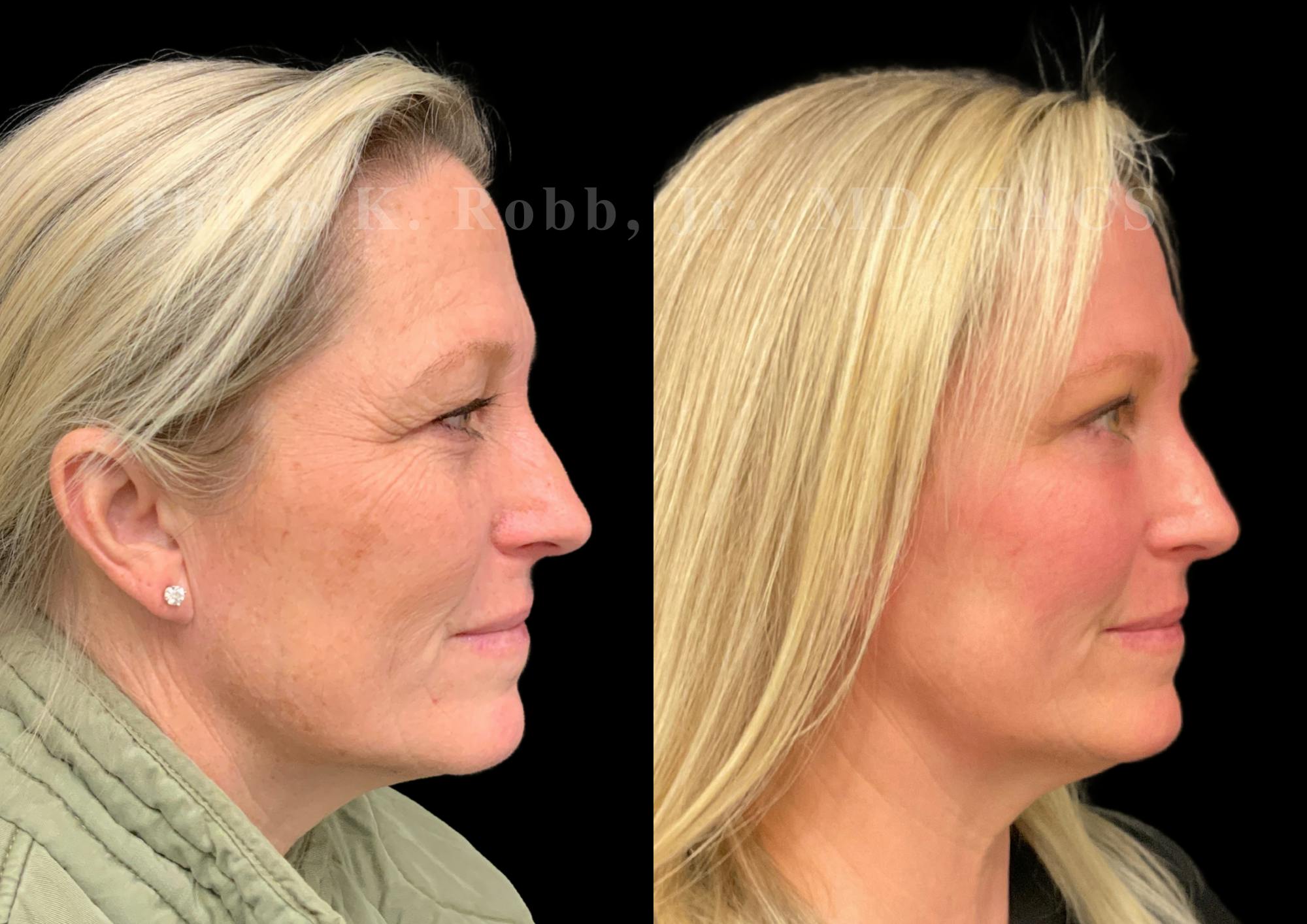 Brow Lift Before & After Gallery - Patient 406939 - Image 5