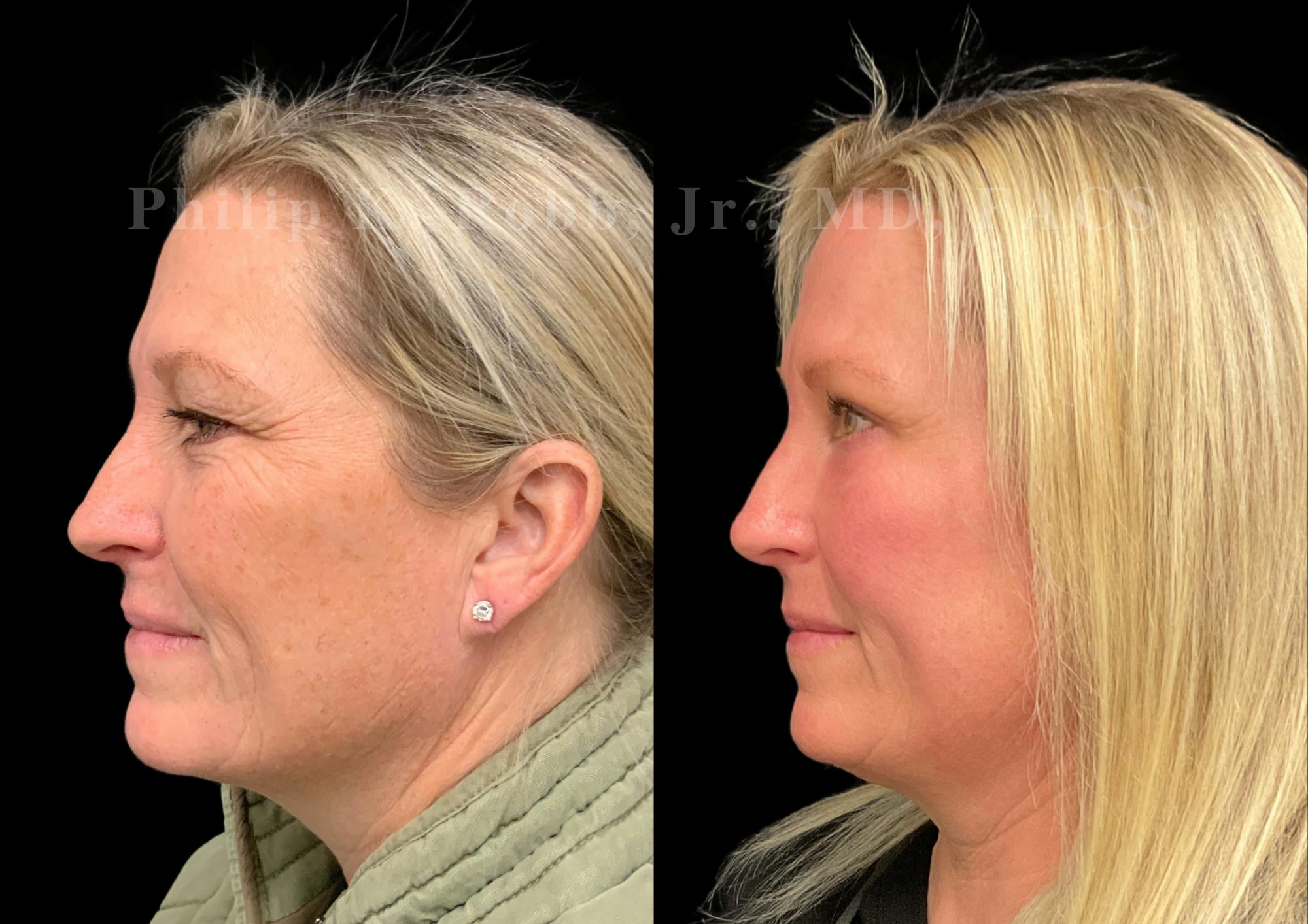 Brow Lift Before & After Gallery - Patient 406939 - Image 3