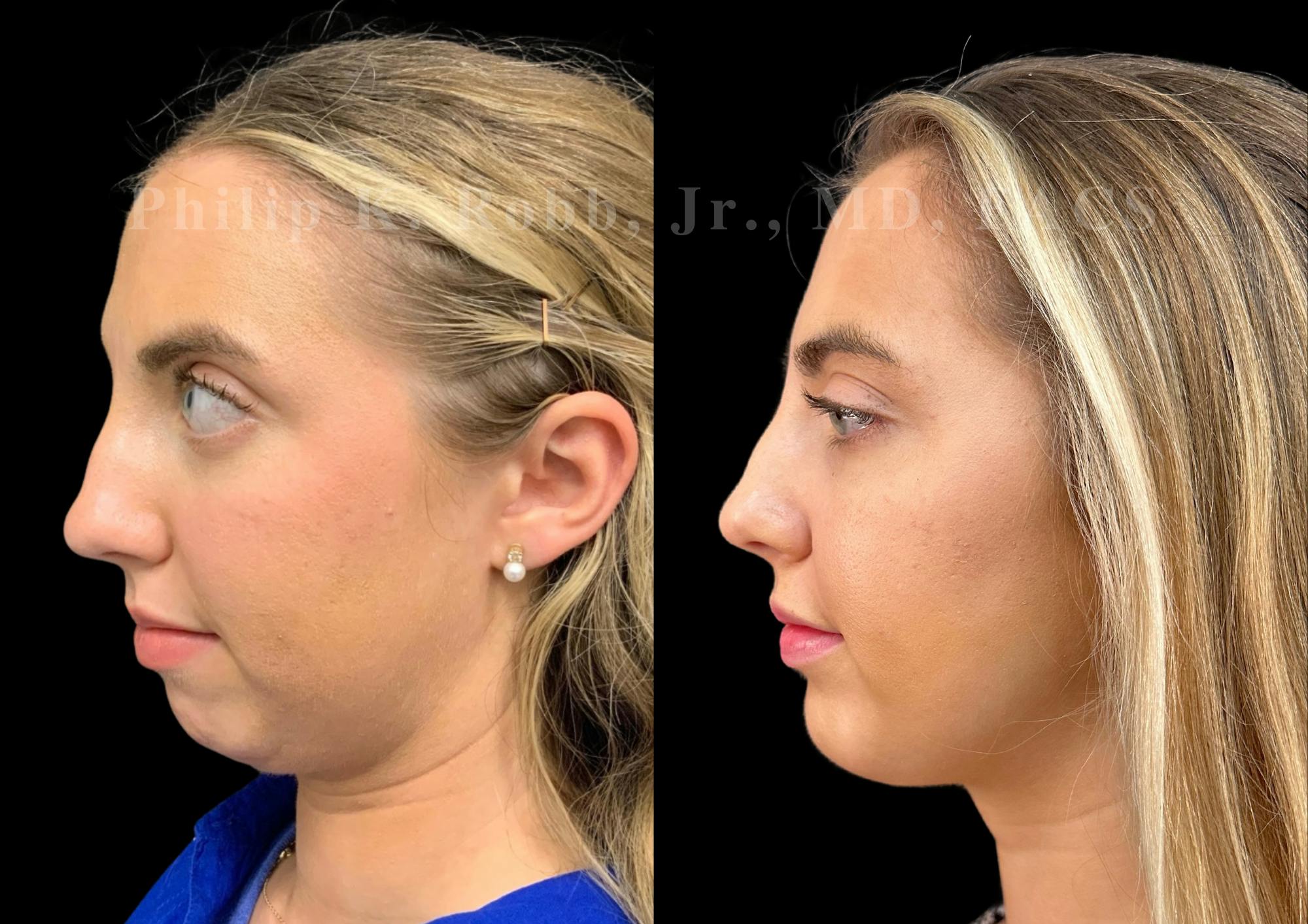 Chin Augmentation Before & After Gallery - Patient 232702 - Image 1