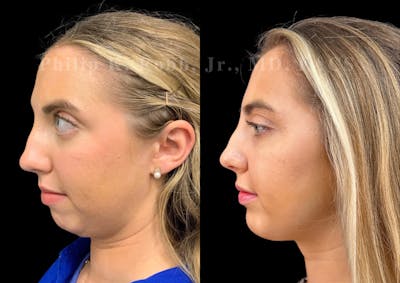Chin Augmentation Before & After Gallery - Patient 232702 - Image 1