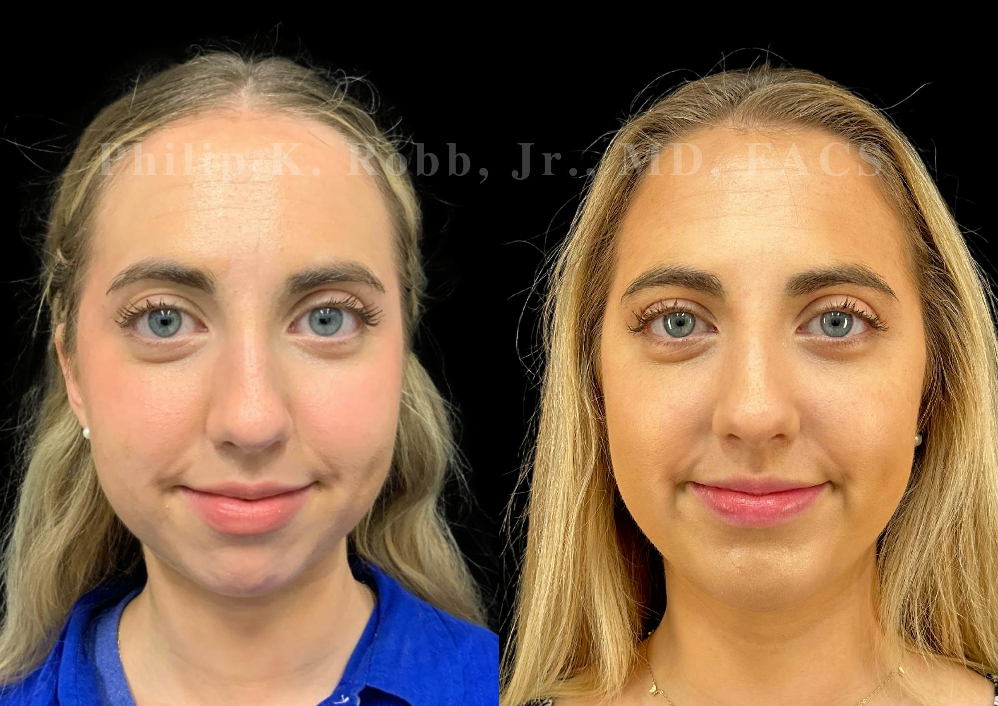 Chin Augmentation Before & After Gallery - Patient 232702 - Image 3