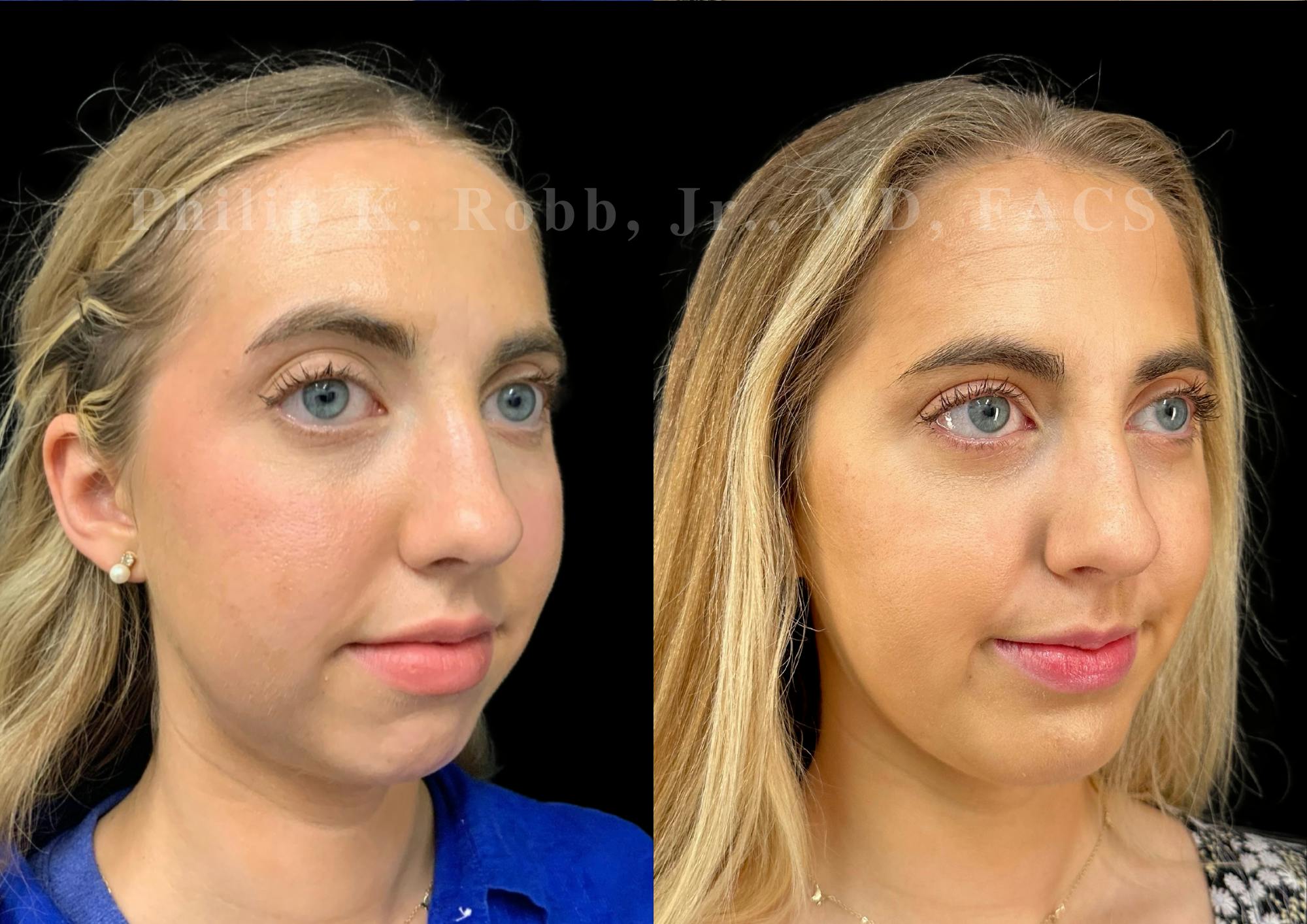 Chin Augmentation Before & After Gallery - Patient 232702 - Image 4