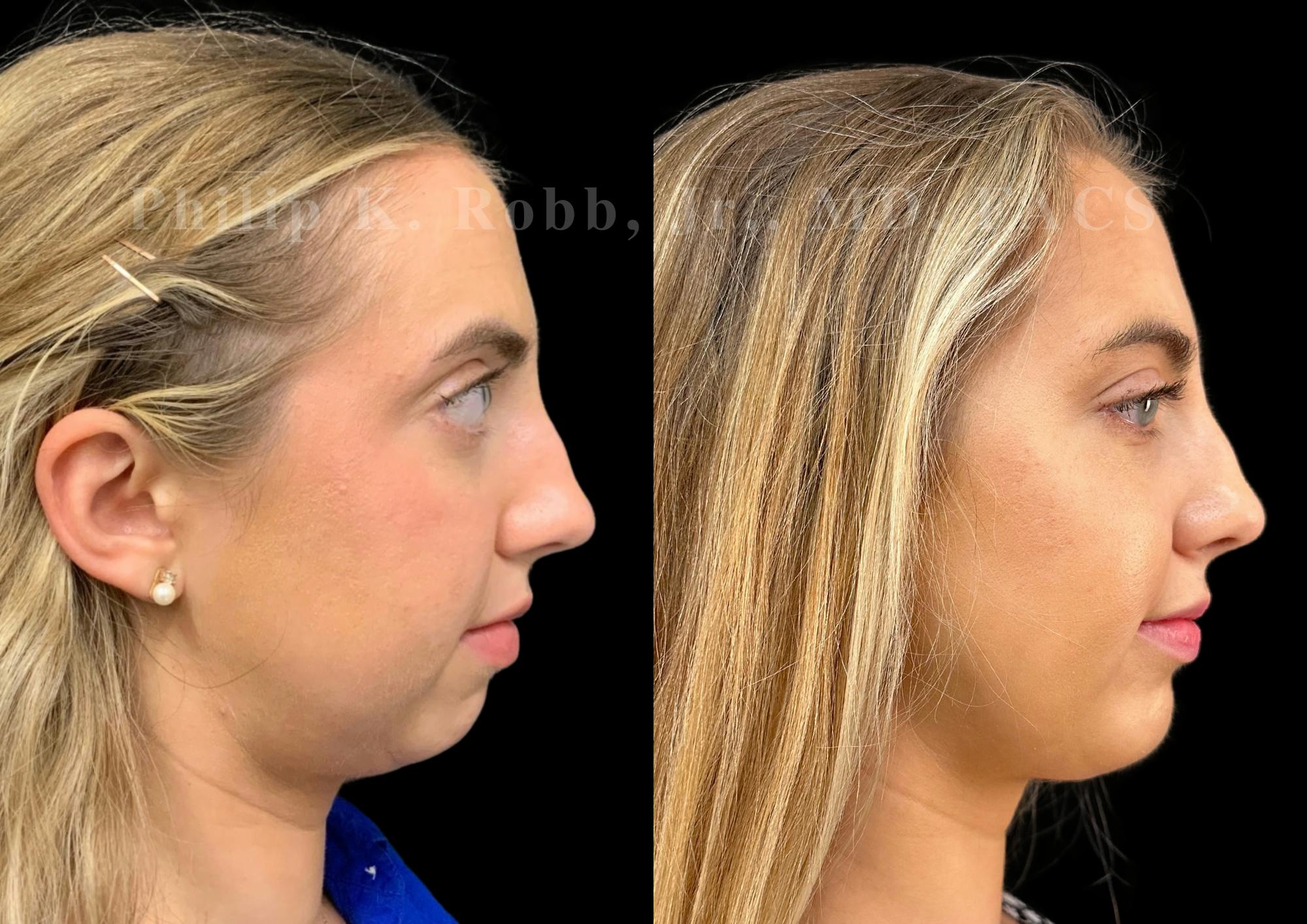 Chin Augmentation Before & After Gallery - Patient 232702 - Image 5