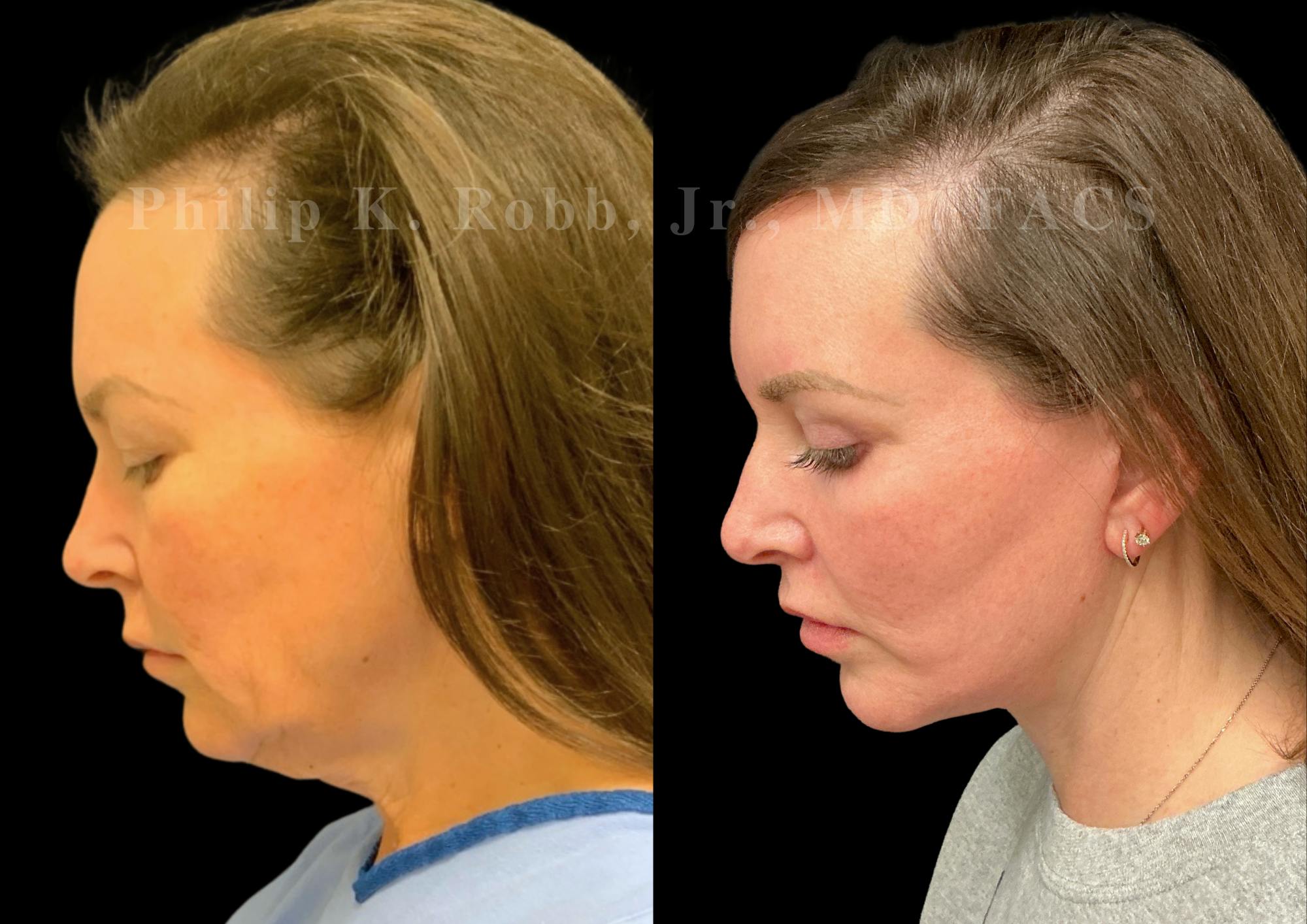 Neck Lift Before & After Gallery - Patient 275718 - Image 2