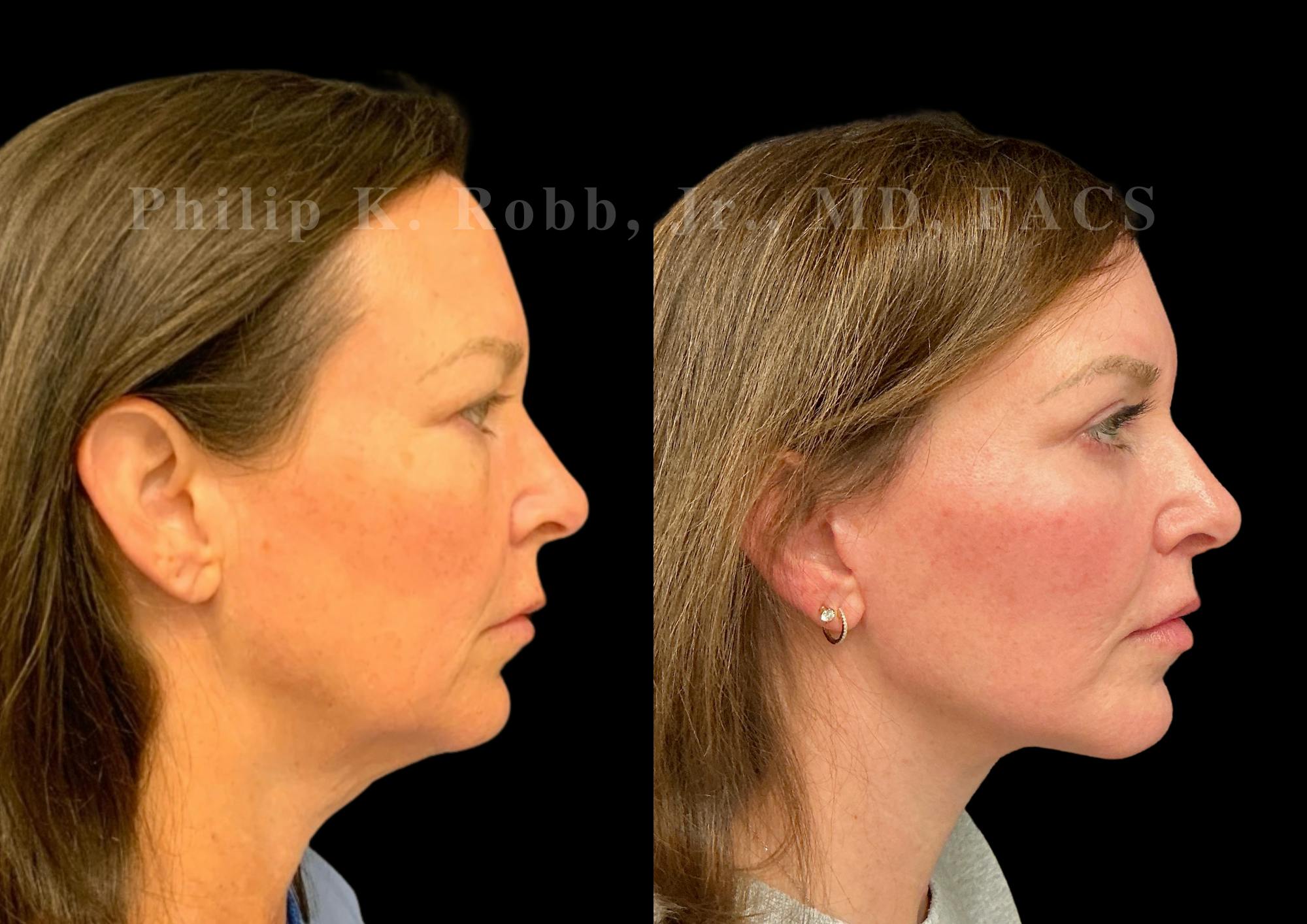 Neck Lift Before & After Gallery - Patient 275718 - Image 6