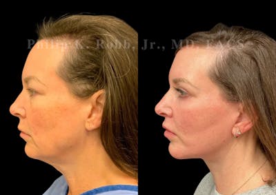 Neck Lift Before & After Gallery - Patient 275718 - Image 1
