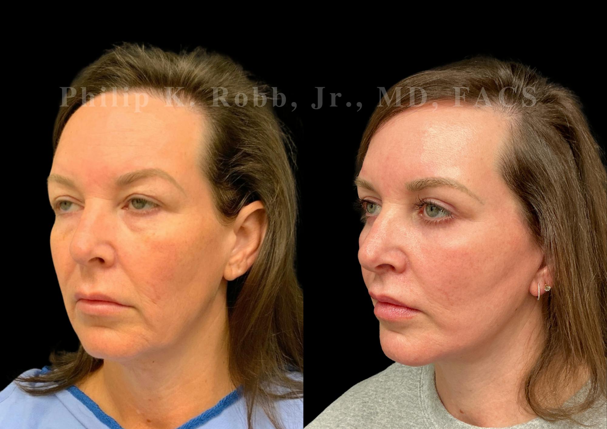 Neck Lift Before & After Gallery - Patient 275718 - Image 3
