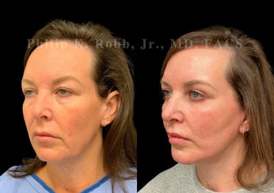 Facelift Before & After Gallery - Patient 132232 - Image 1