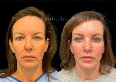 Lip Lift Before & After Gallery - Patient 127572 - Image 1