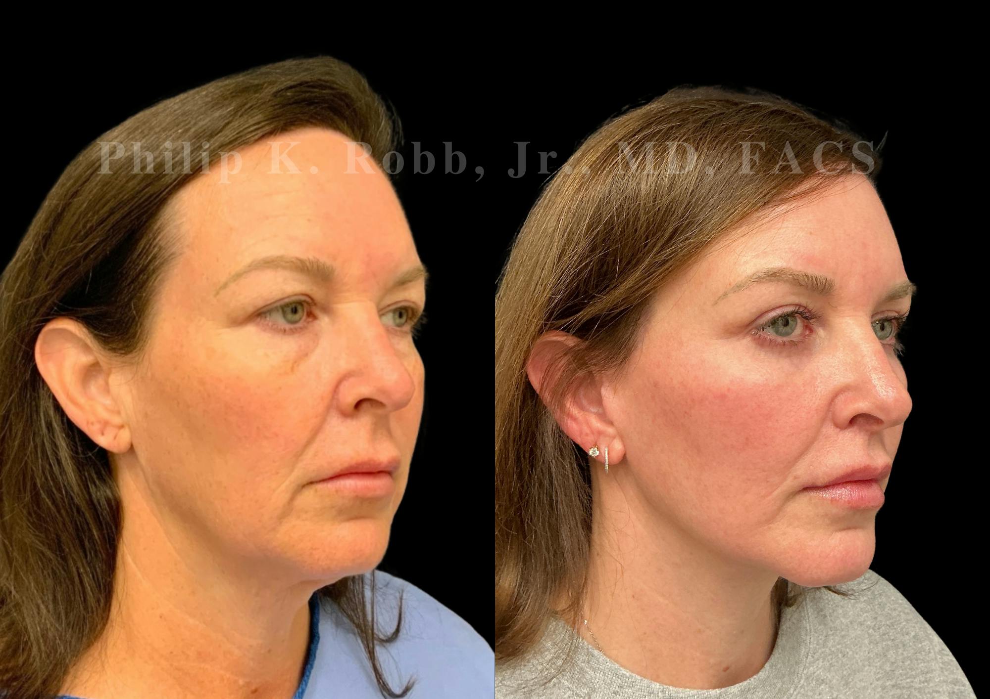 Neck Lift Before & After Gallery - Patient 275718 - Image 5