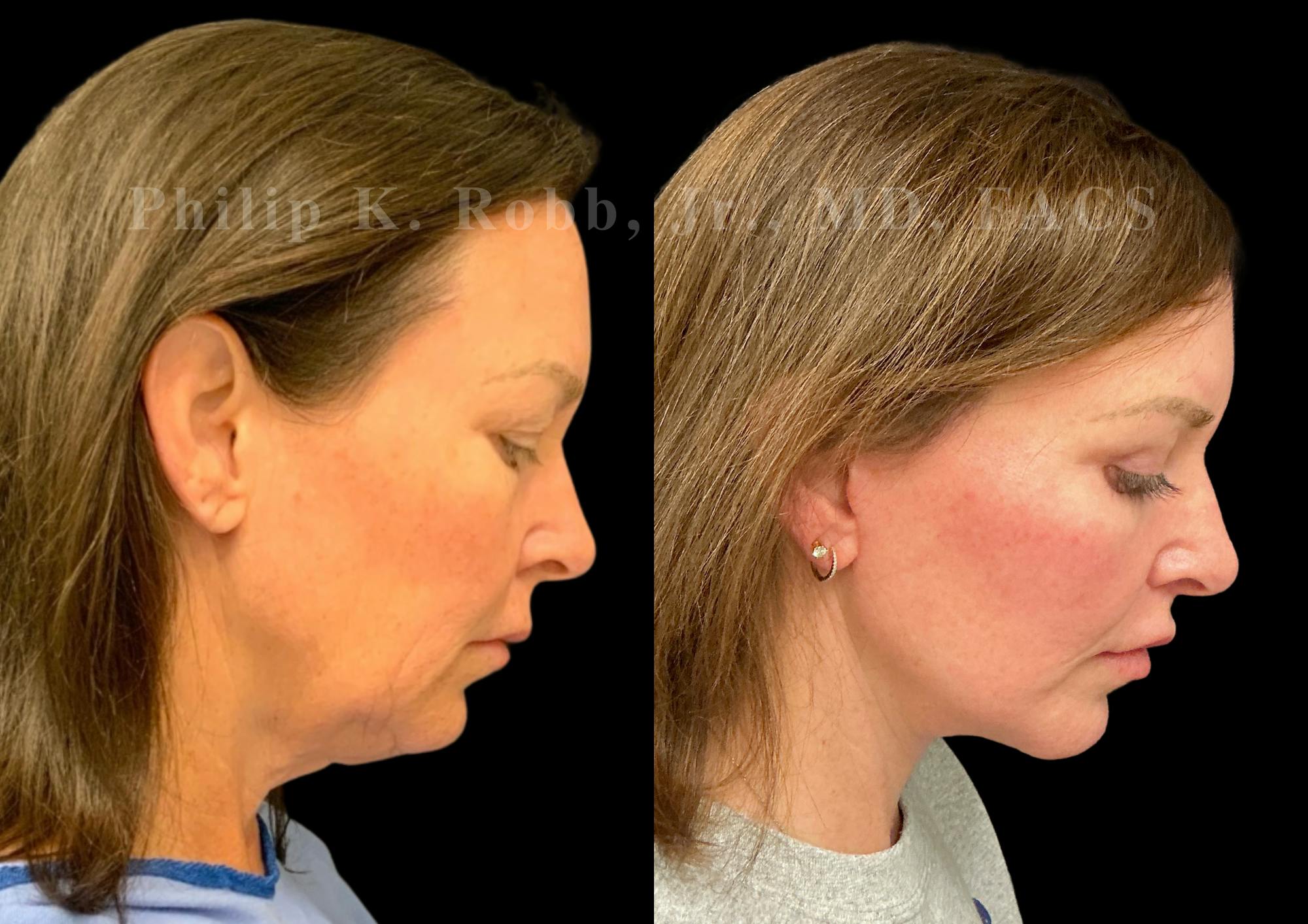 Neck Lift Before & After Gallery - Patient 275718 - Image 7