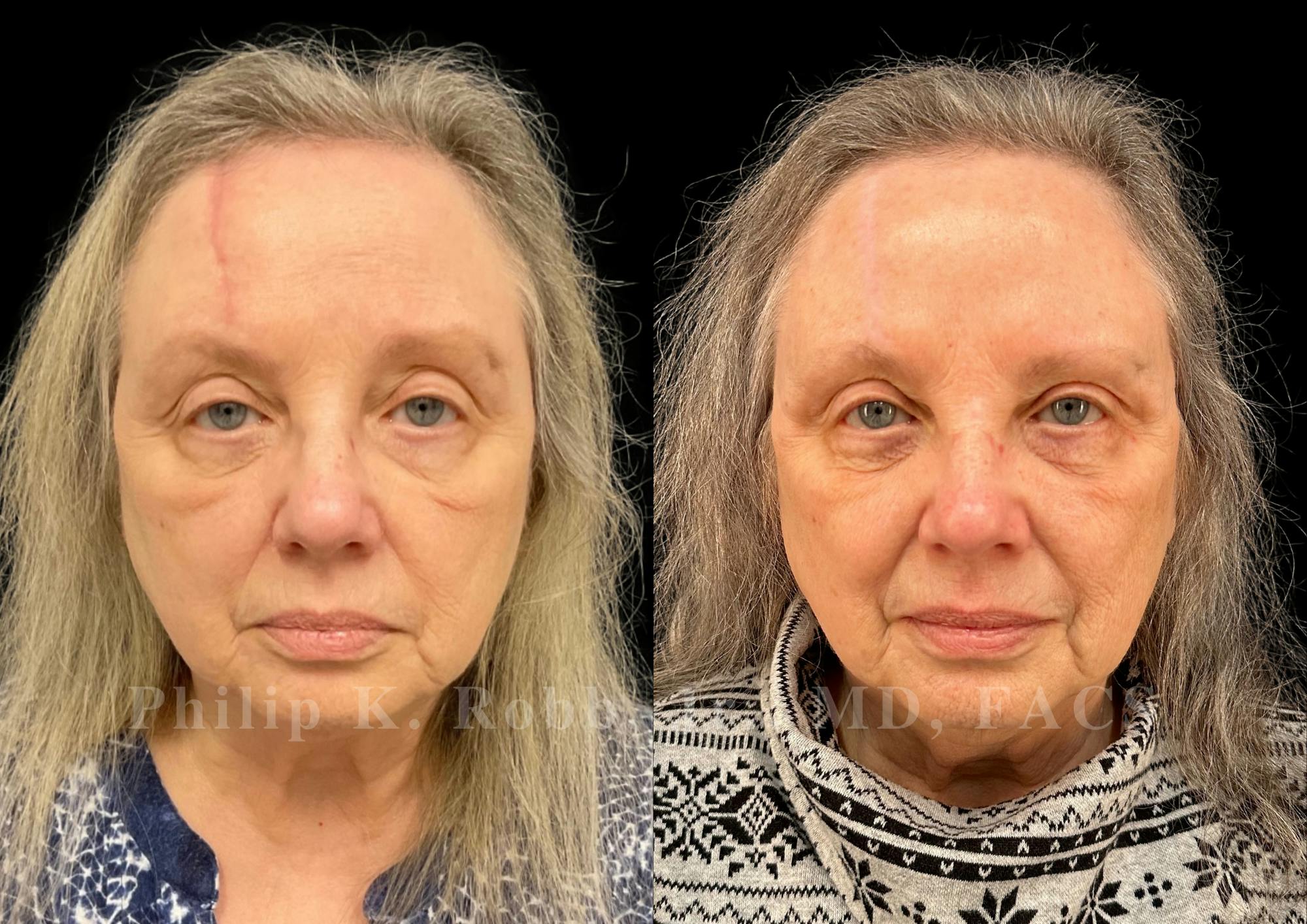 Scar Revision Before & After Gallery - Patient 387122 - Image 1