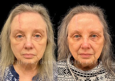 Scar Revision Before & After Gallery - Patient 387122 - Image 1