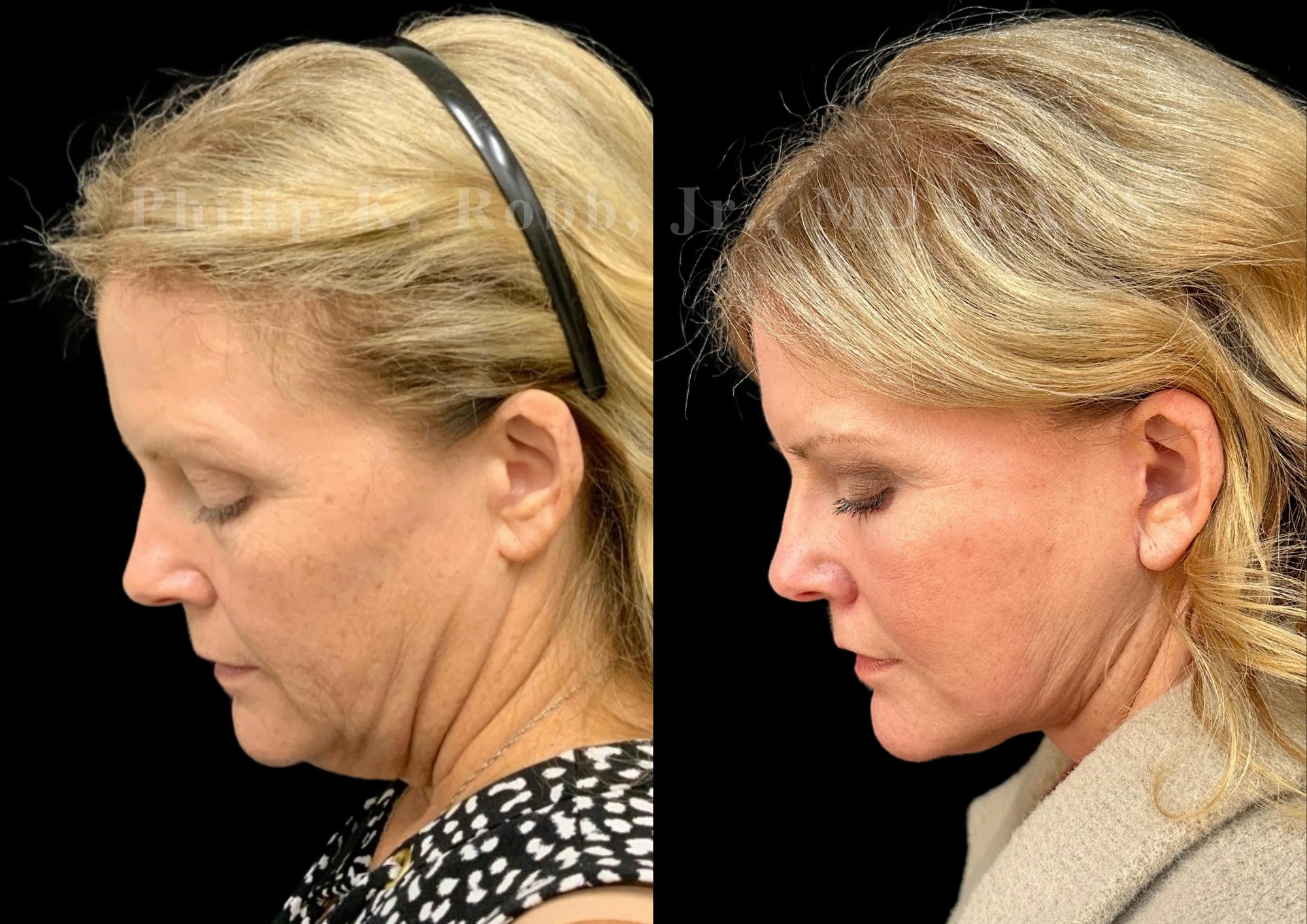 Neck Lift Before & After Gallery - Patient 306570 - Image 2