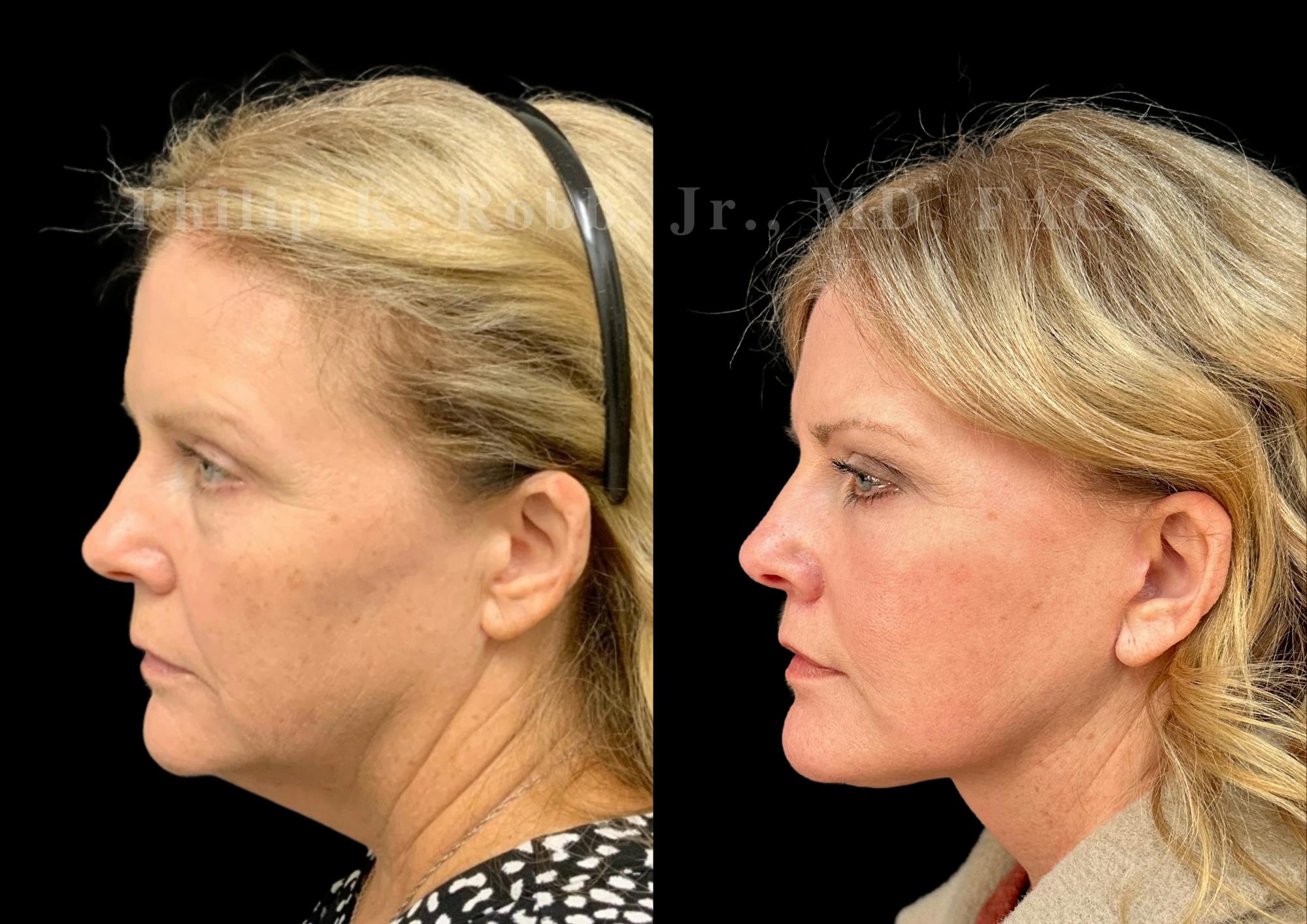 Neck Lift Before & After Gallery - Patient 306570 - Image 1
