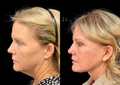Neck Lift Before & After Gallery - Patient 306570 - Image 1
