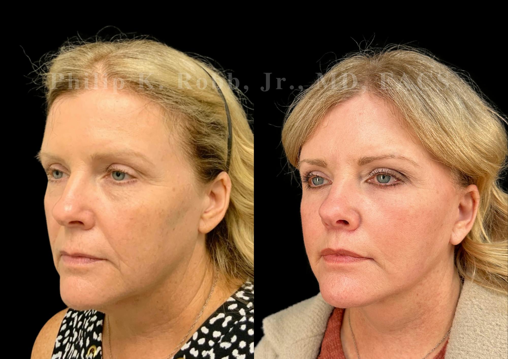 Neck Lift Before & After Gallery - Patient 306570 - Image 3