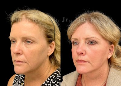 Facelift Before & After Gallery - Patient 268798 - Image 1
