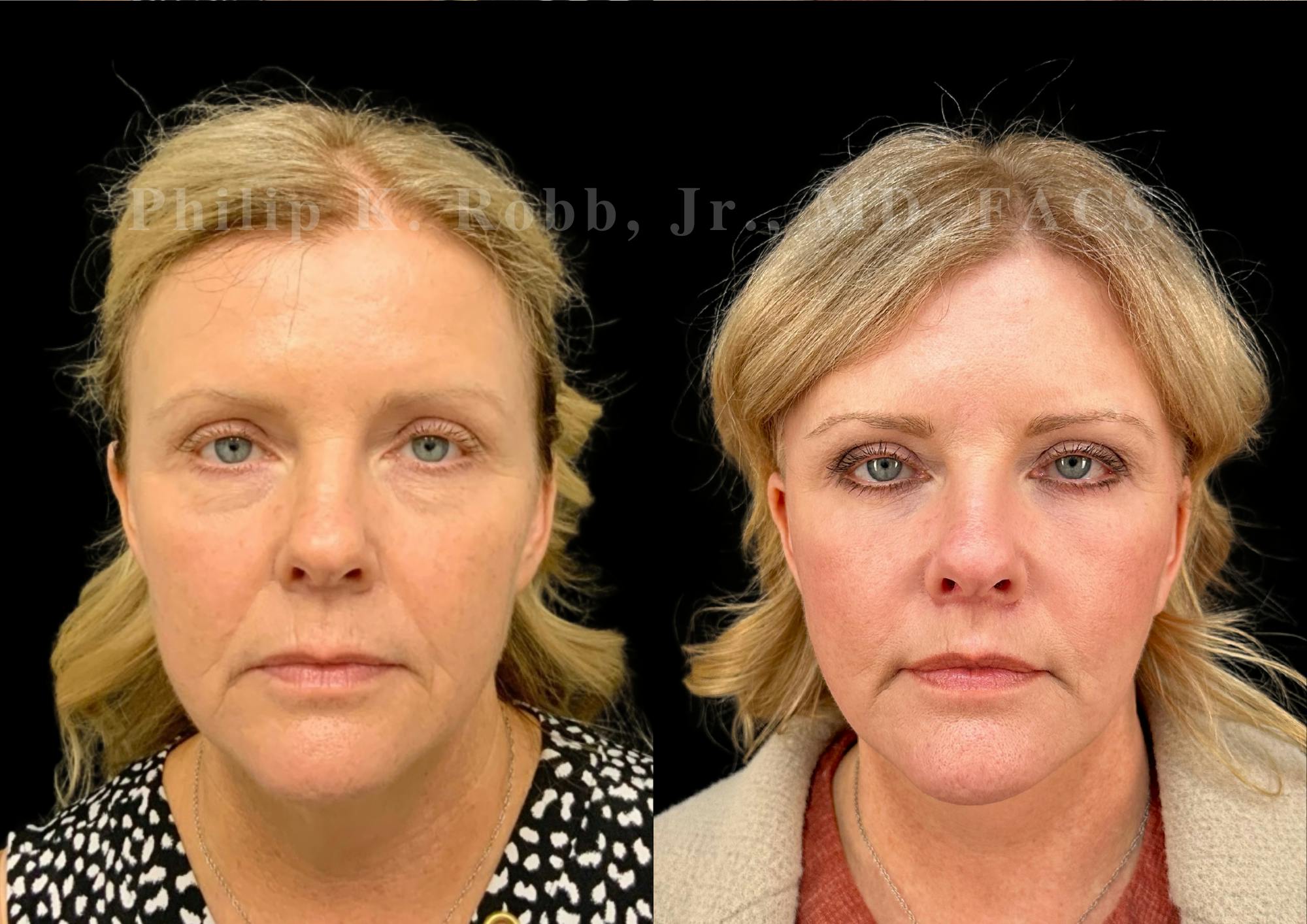 Neck Lift Before & After Gallery - Patient 306570 - Image 4